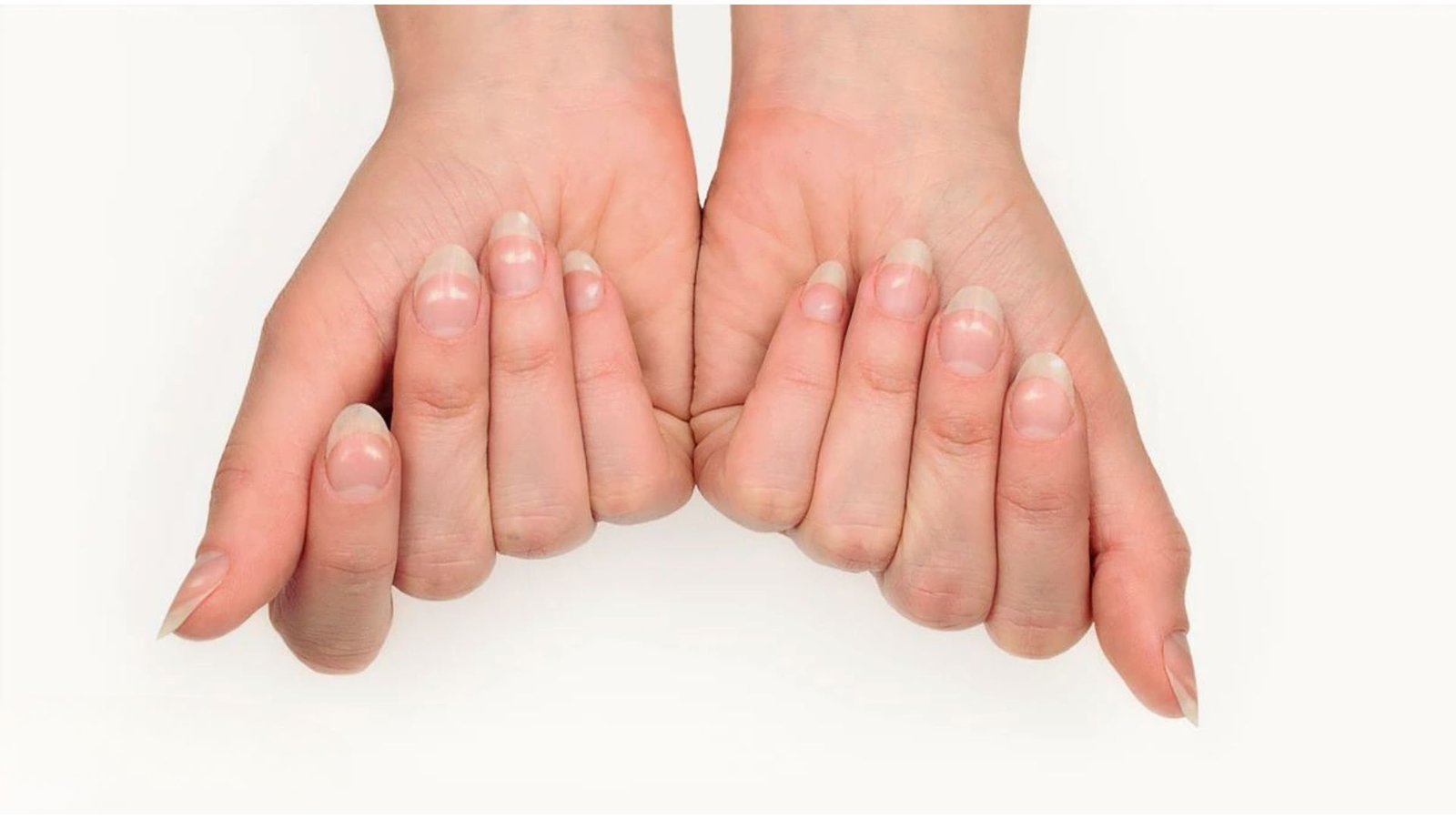 Can White Spots on Nails Indicate Health Conditions