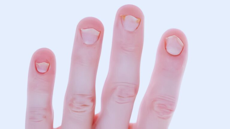 Nails Lifting From Nail