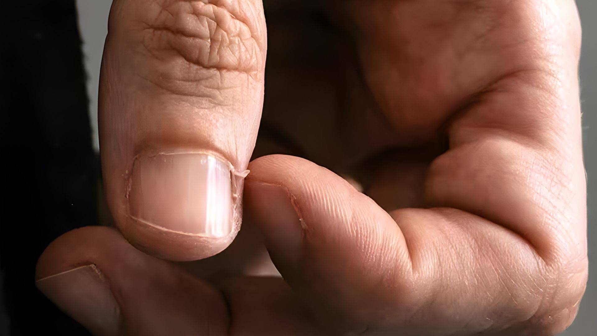 What Causes Hangnails