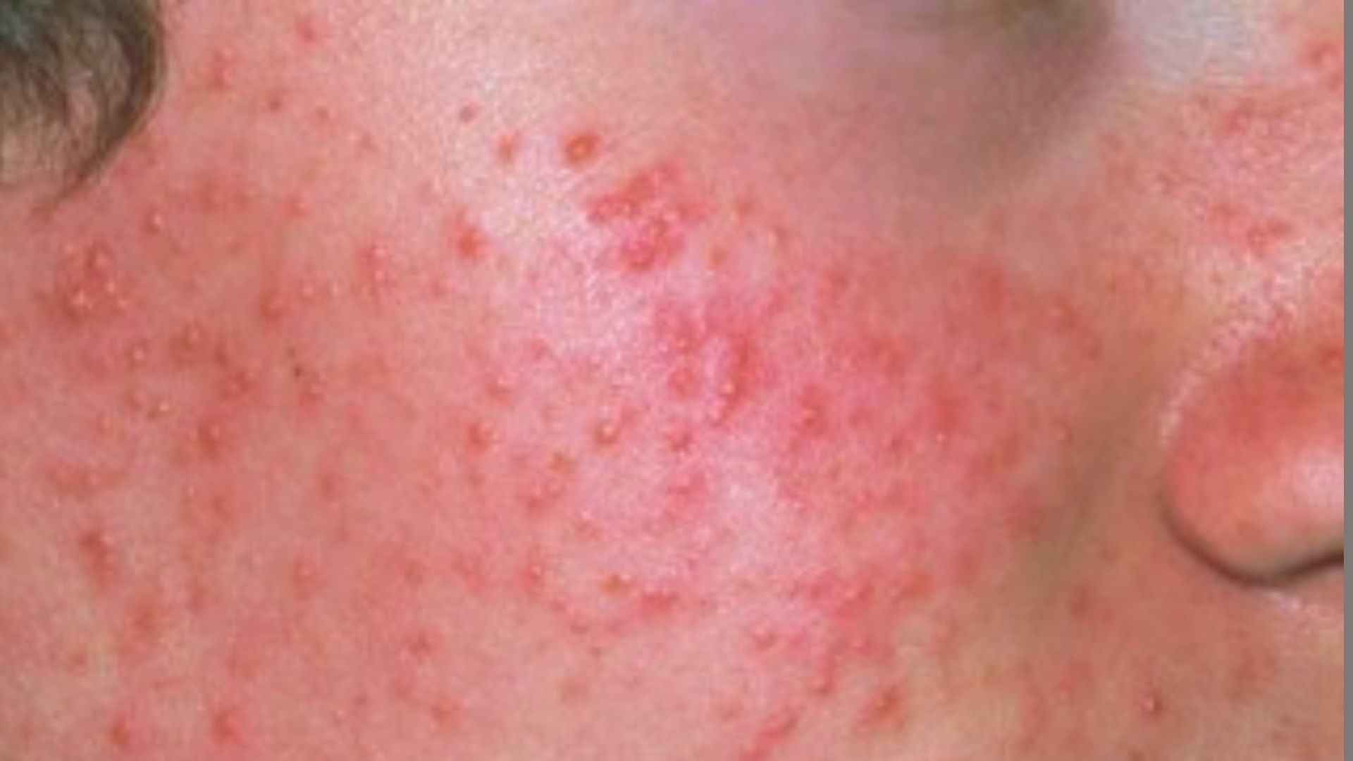 What Is Acne