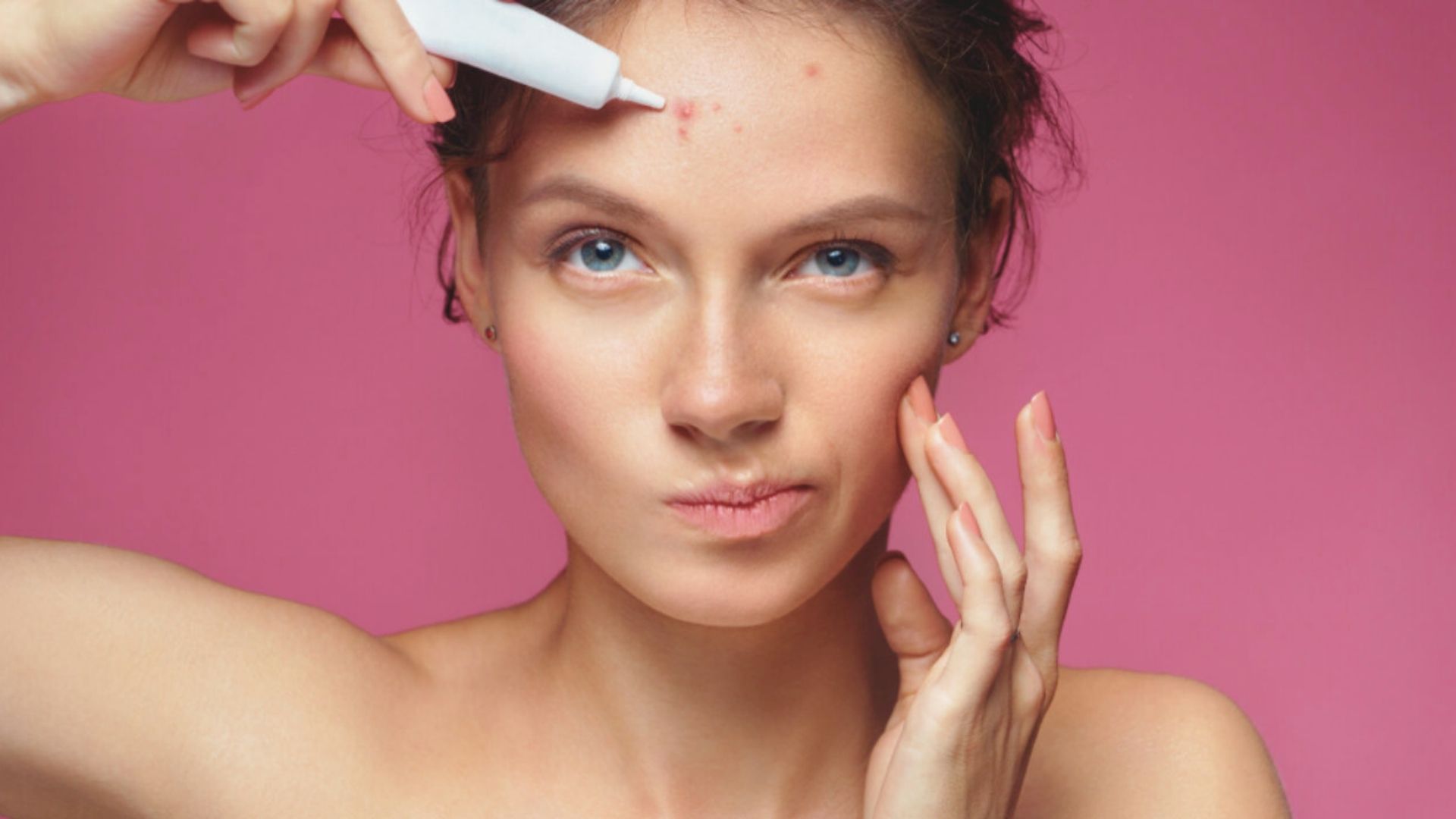 What to Do About Forehead Breakouts