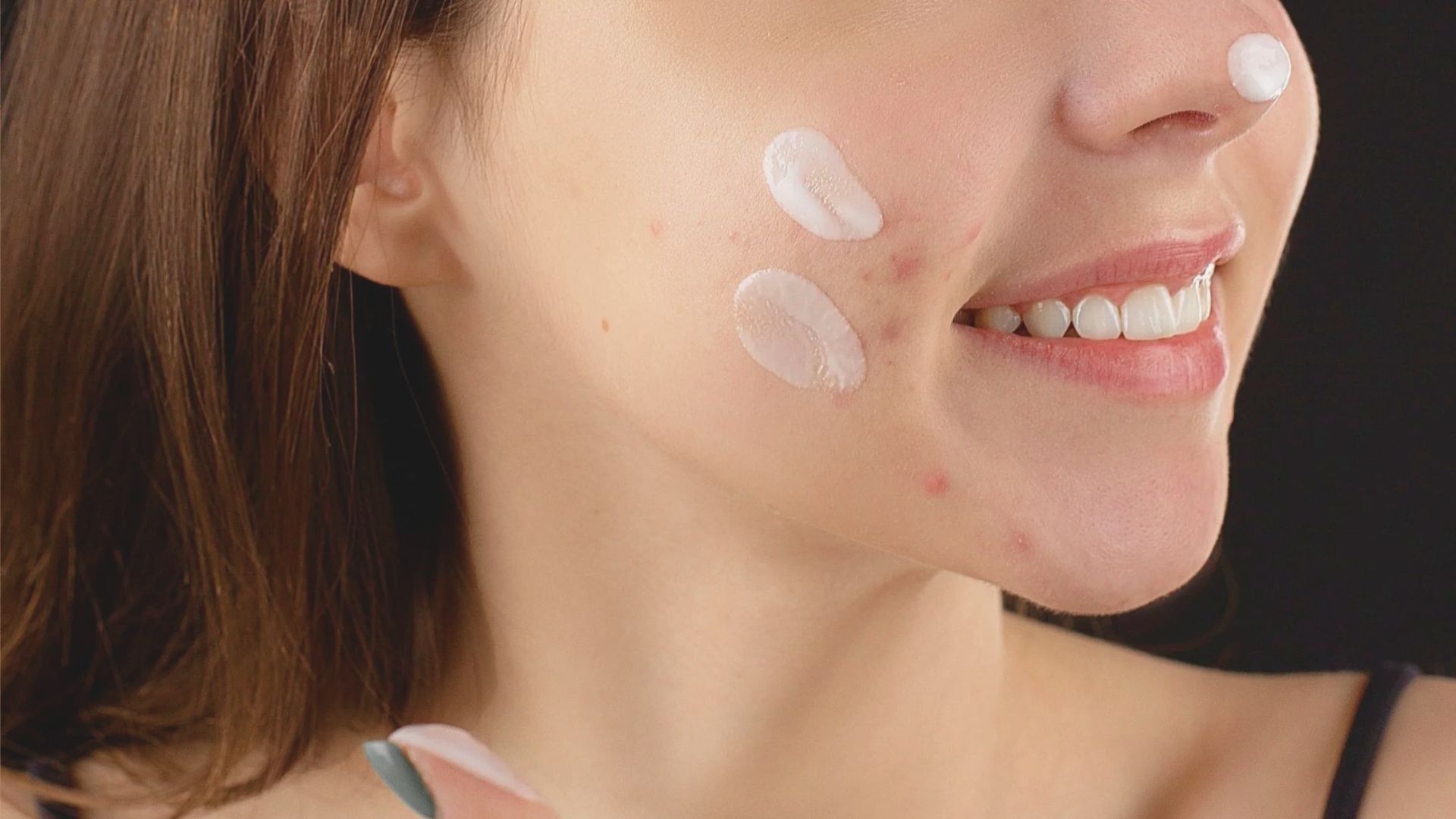 Does Niacinamide Help With Acne Scars