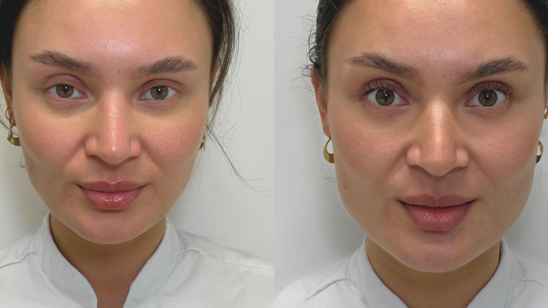 Effects of Botox on Facial Appearance