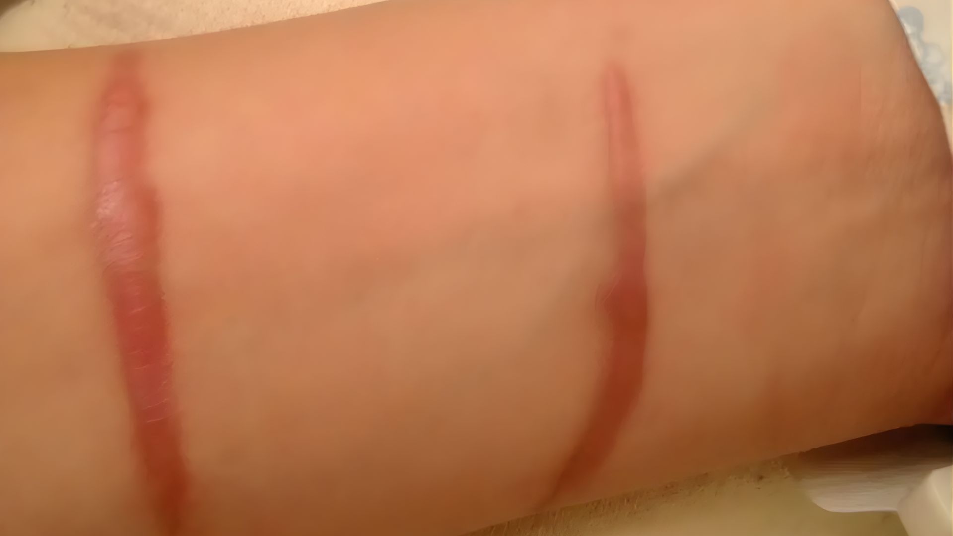 Stage 1: Inflammation Phase (Red to Reddish-Purple)