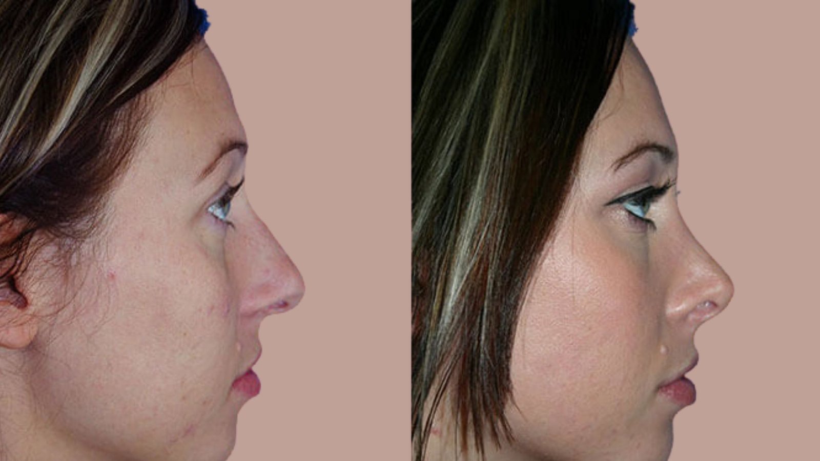 Does Septoplasty Change