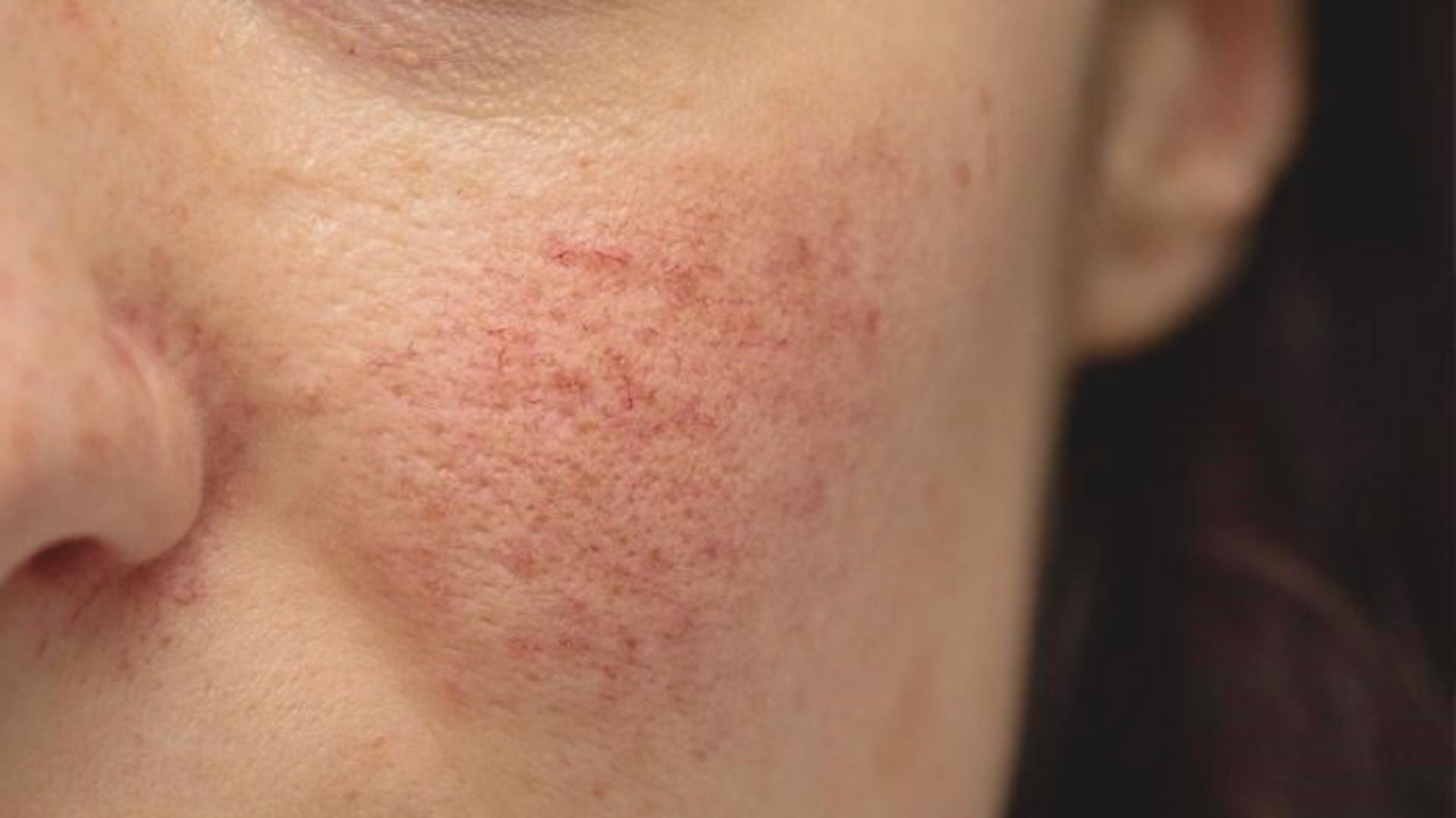 What Is Rosacea