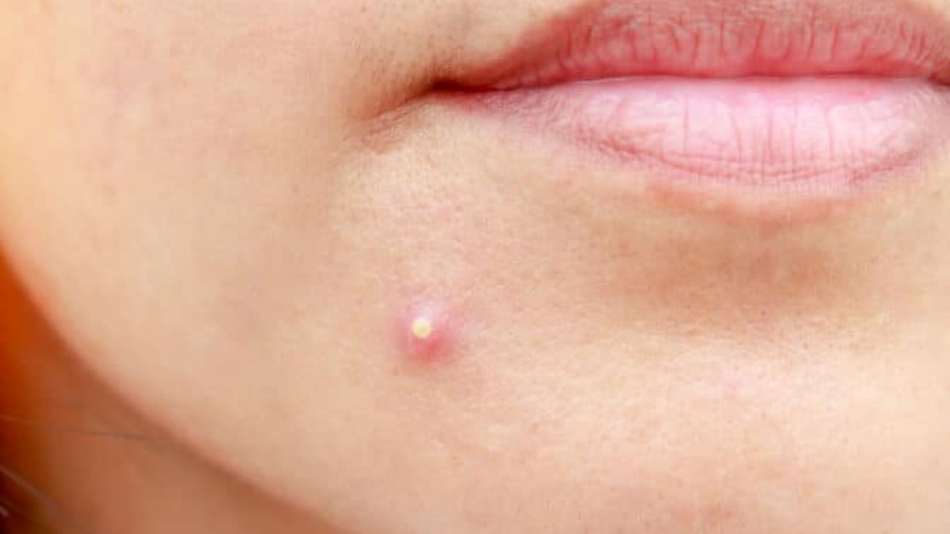 Key Characteristics of Pimples