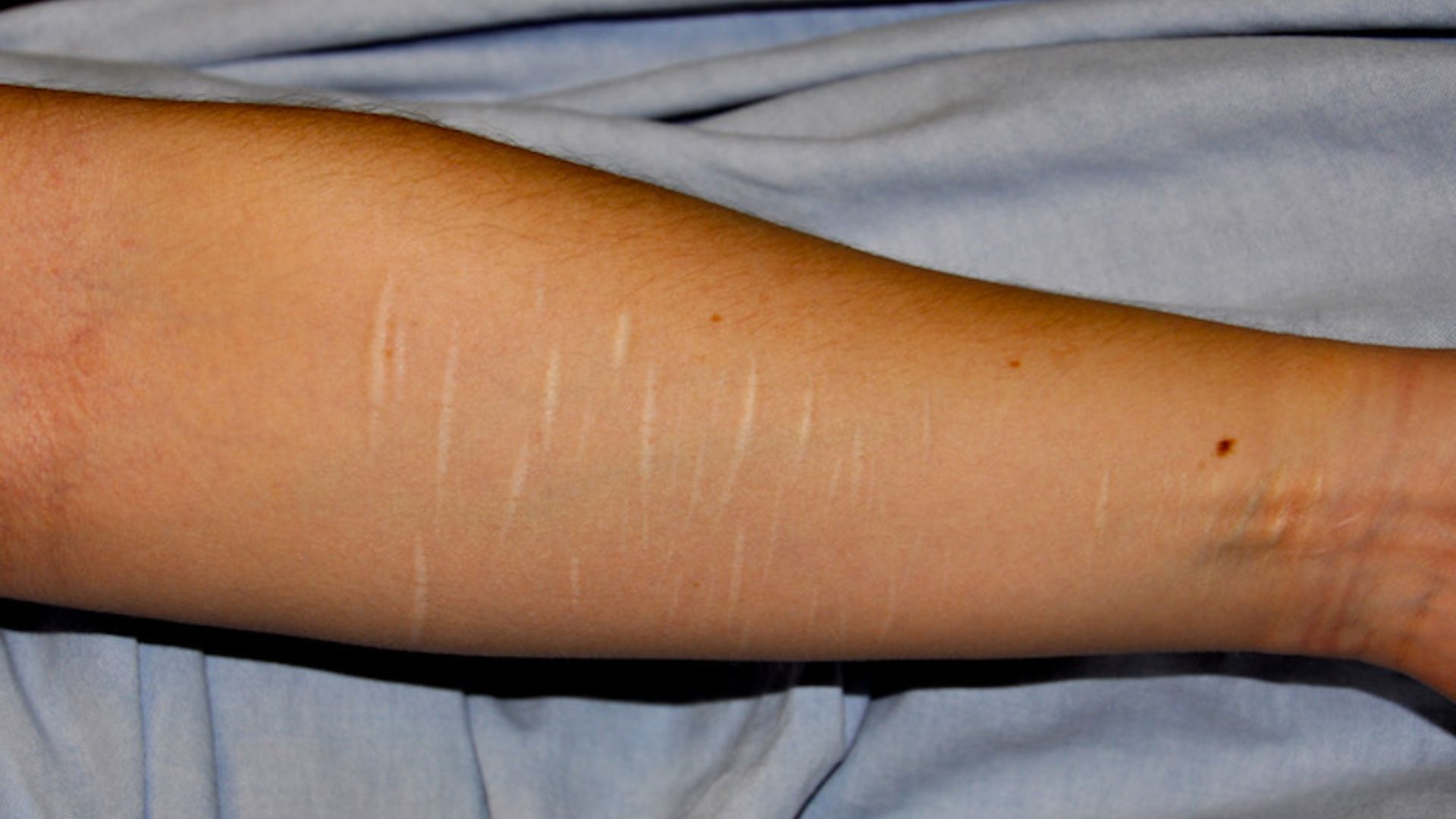 Fresh vs. Older Scars