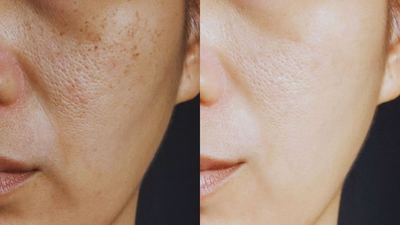 Which Treatment Is Better for Your Skin