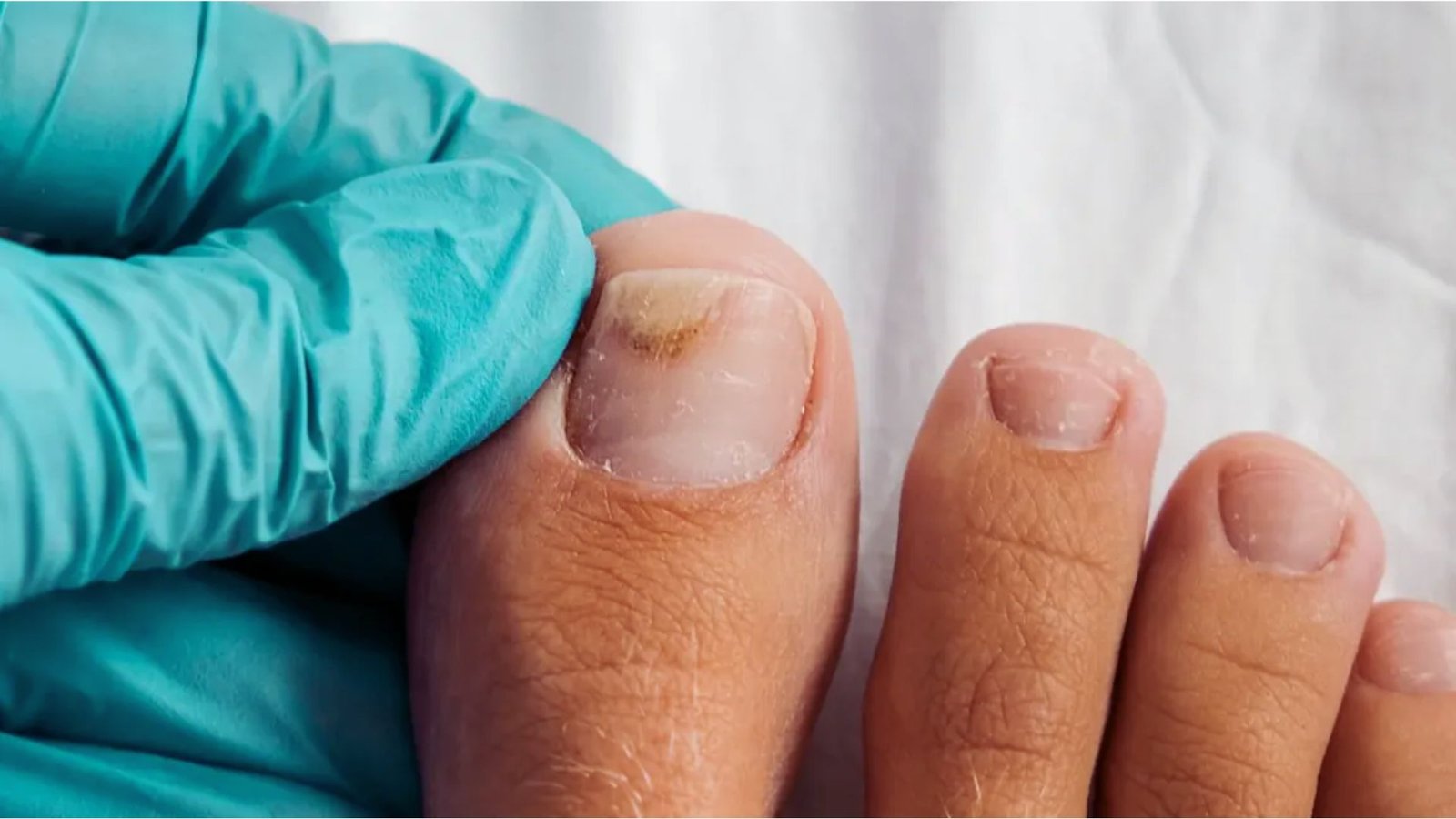 How Long Injury-Related White Spots Take to Grow Out