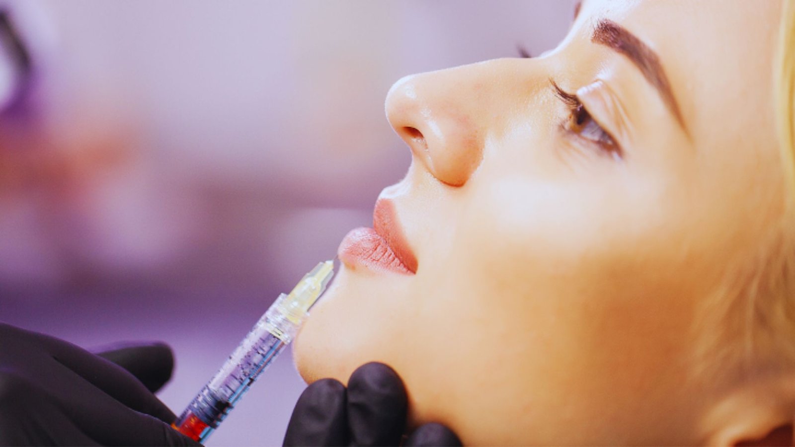 Is Lip Filler Permanent