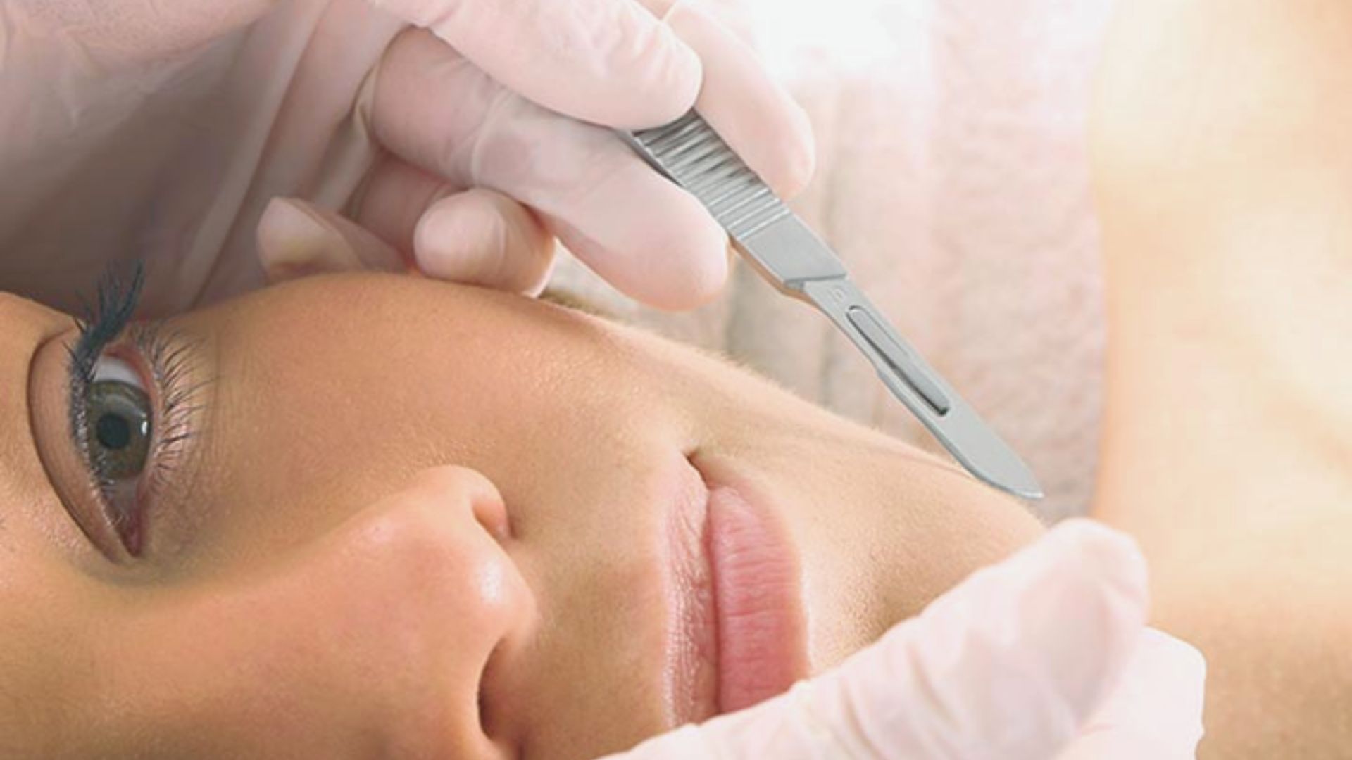 What is Dermaplaning
