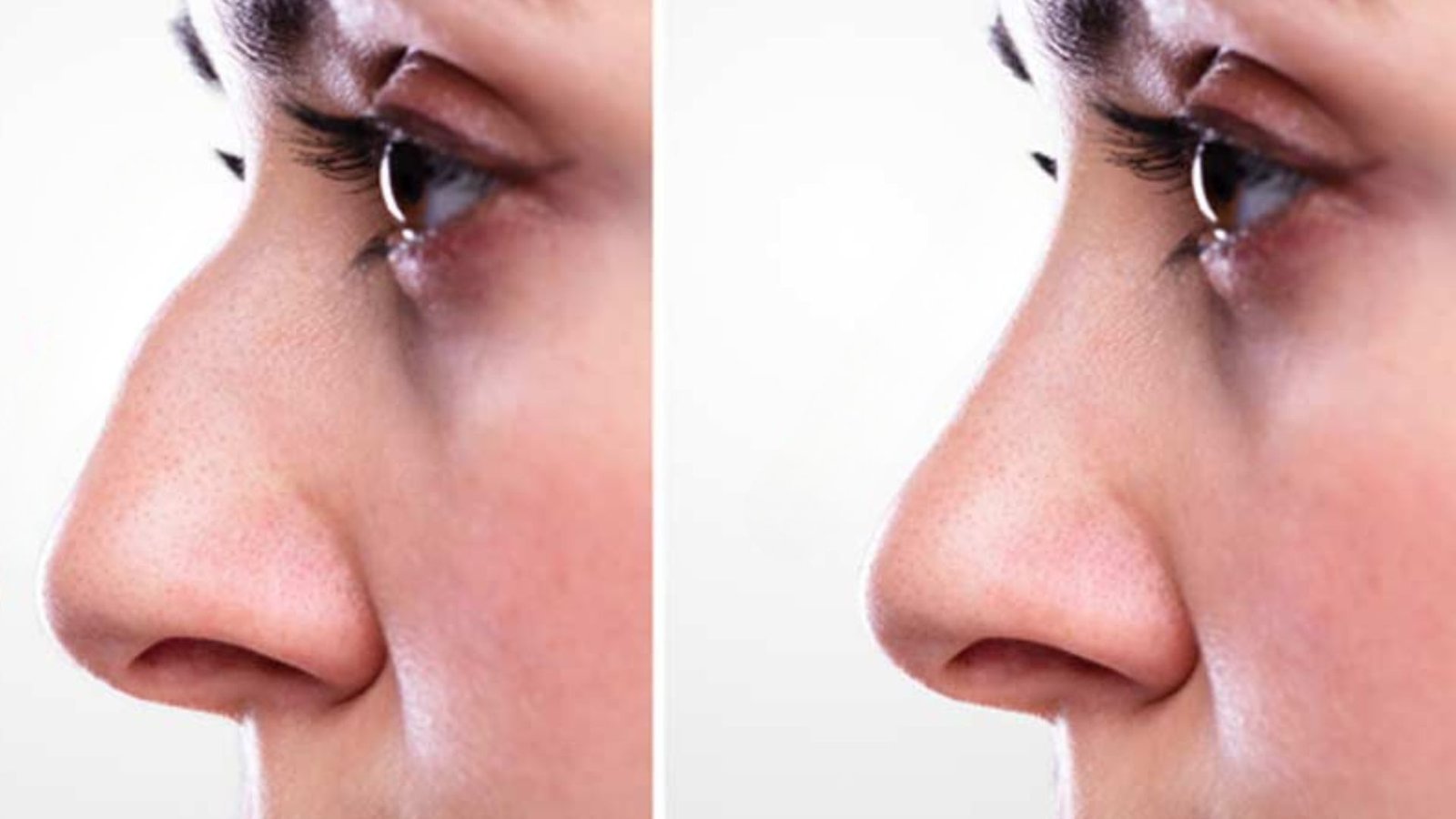 Limitations of Septoplasty on Cosmetic Changes