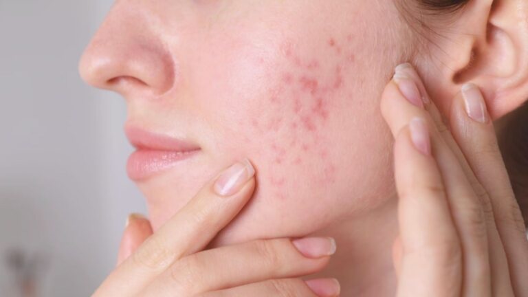 Types of Acne Scars