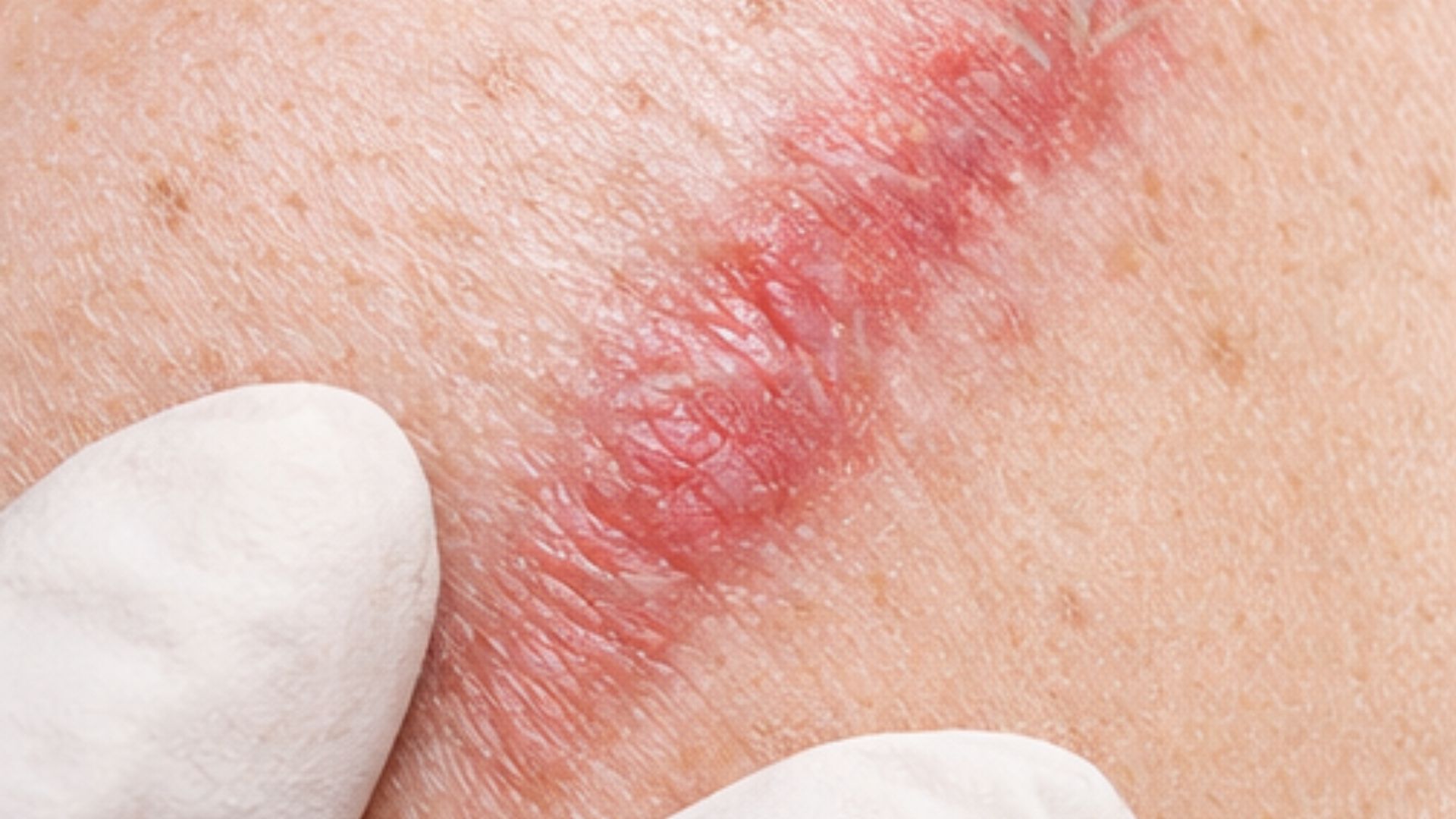 Melanin and Skin Pigmentation