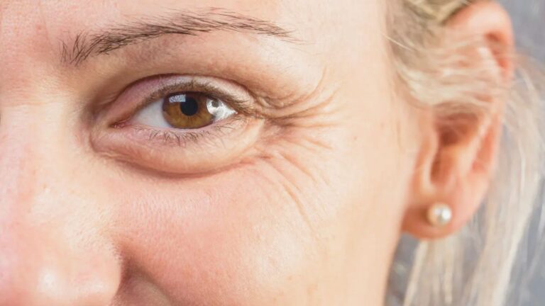 Eye Wrinkles When Smiling