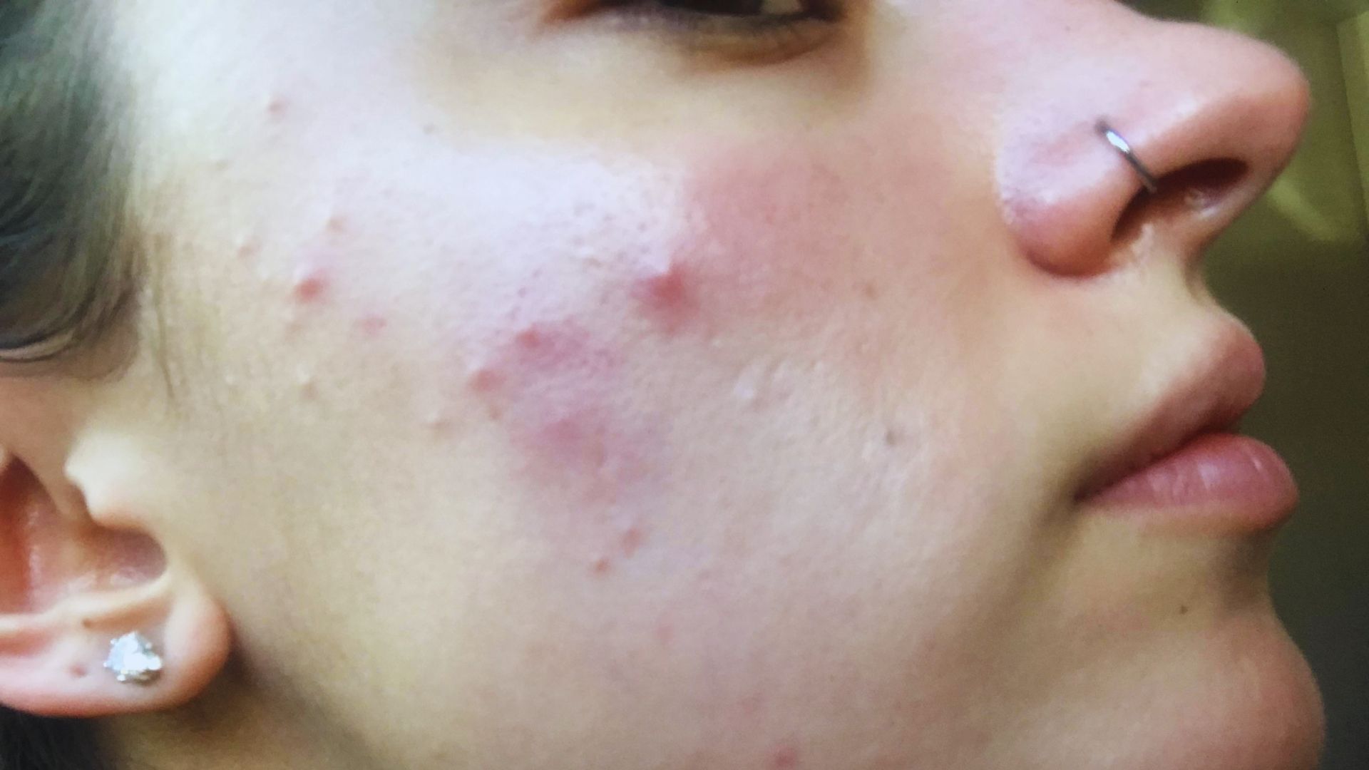 A woman with visible acne on her face, highlighting several pimples and skin texture.