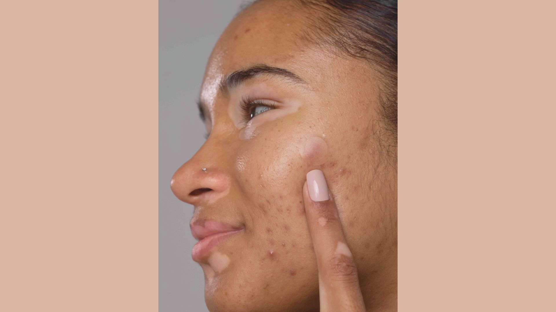 A woman with visible acne on her face, highlighting a pimple patch on a blackhead.