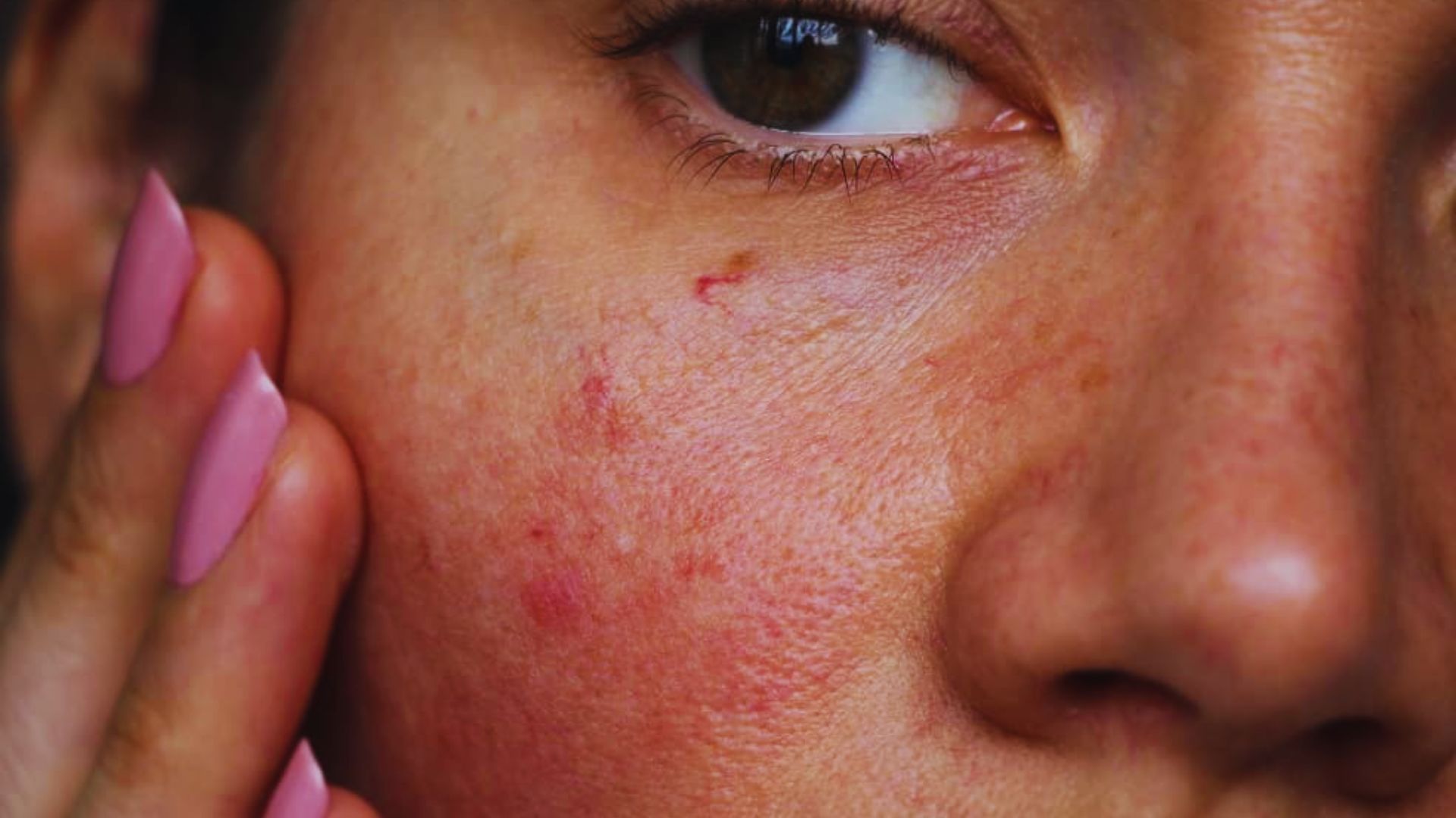 Allergic Reactions and Sensitive Skin
