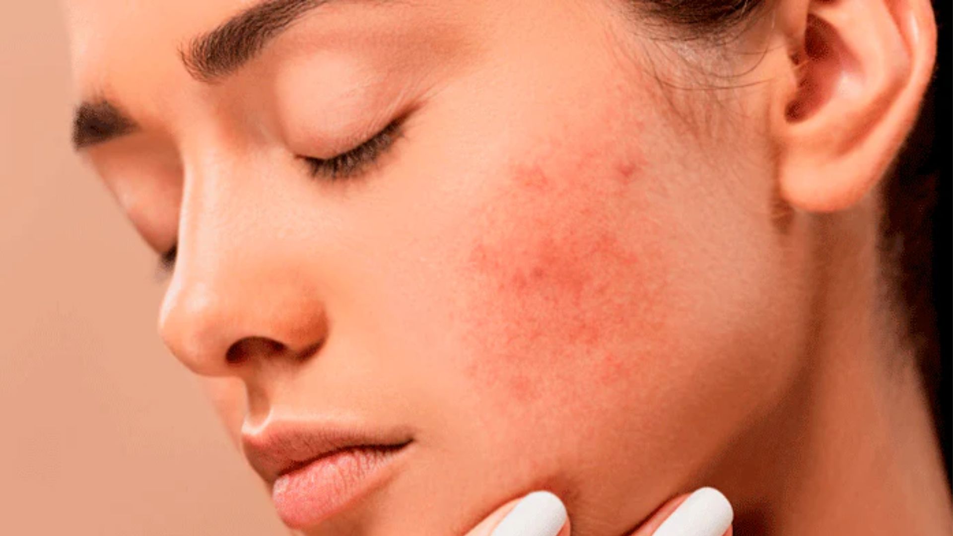 Image illustrating acne, a common skin condition, with a note on visible improvement and clearer skin from weeks 8-12.