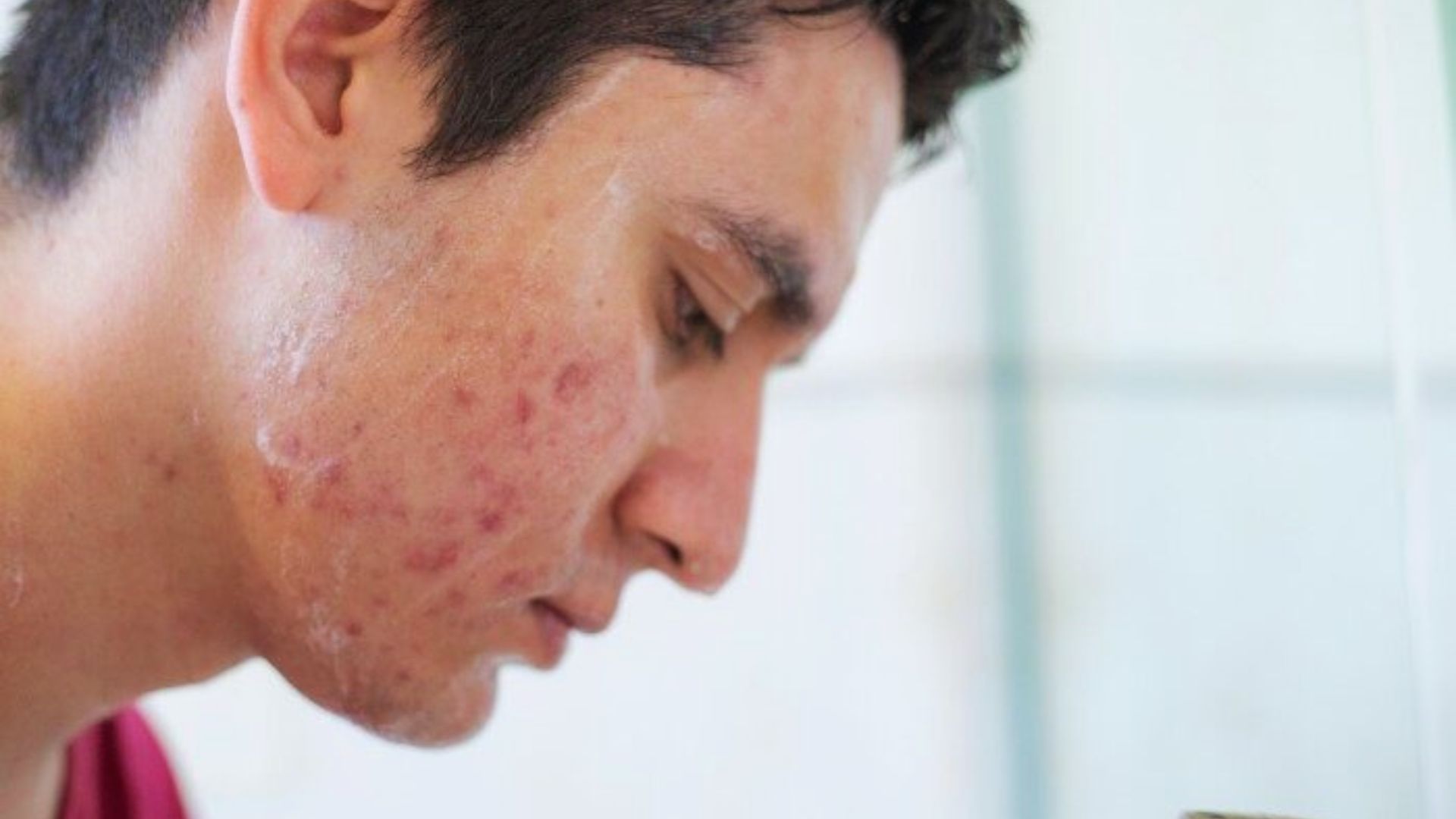 A man with acne on his face, illustrating the impact of hard water on skin health.
