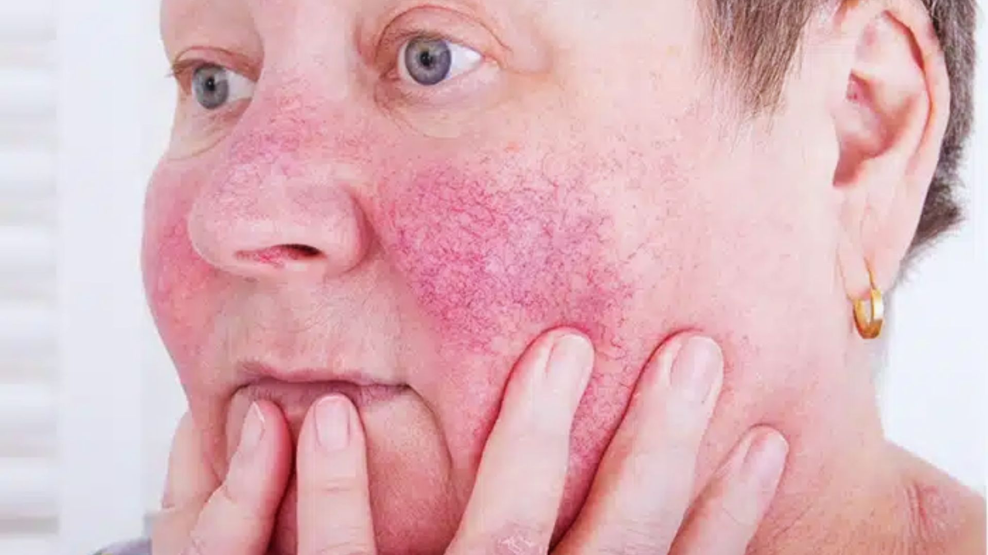 A woman displaying red skin on her face, a common sign of rosacea, with a neutral expression.