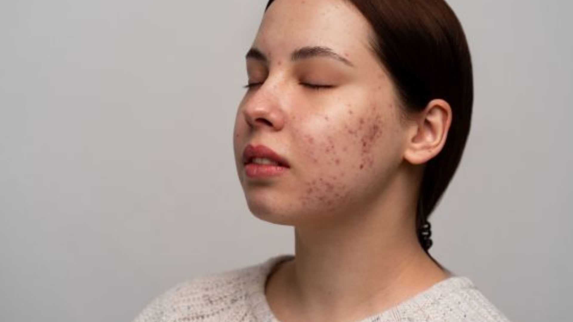 A woman with acne on her face, illustrating skin concerns related to retinol and adapalene use.