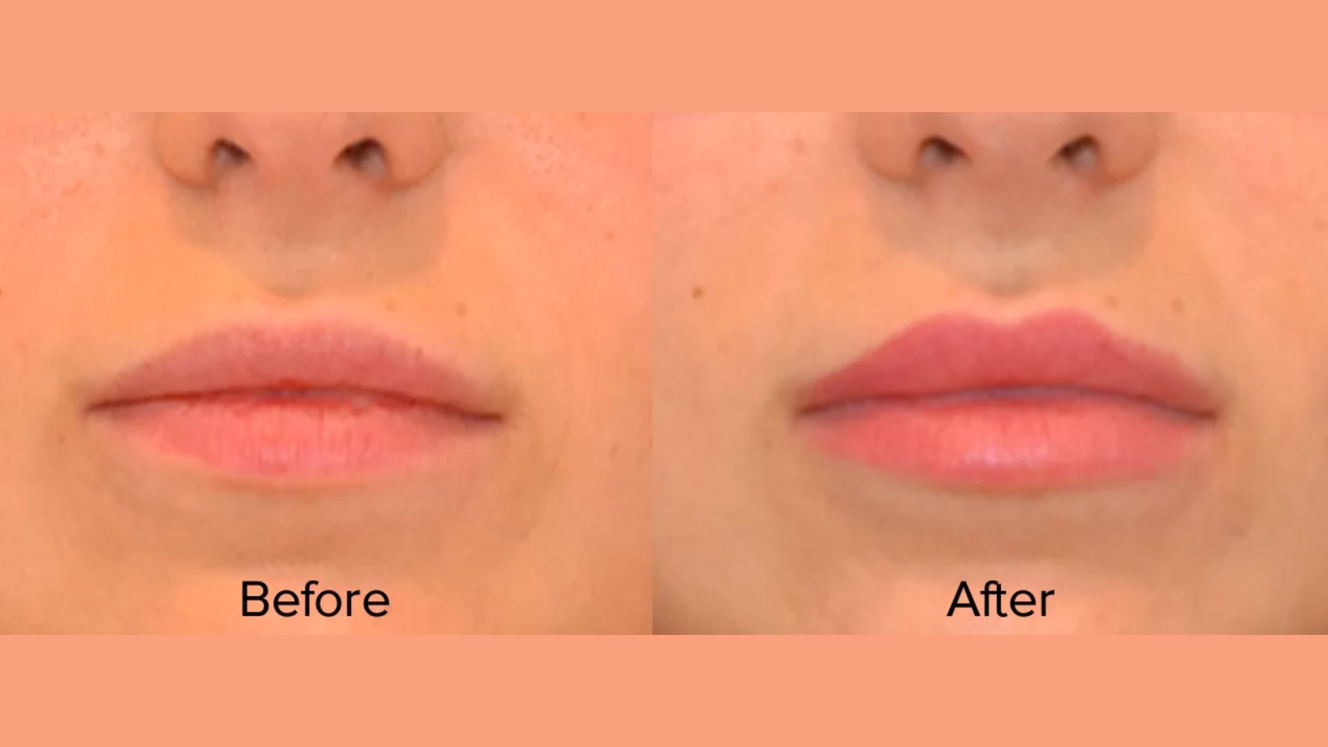 Before and after images showcasing the results of a lip lift procedure, highlighting enhanced lip fullness and shape.