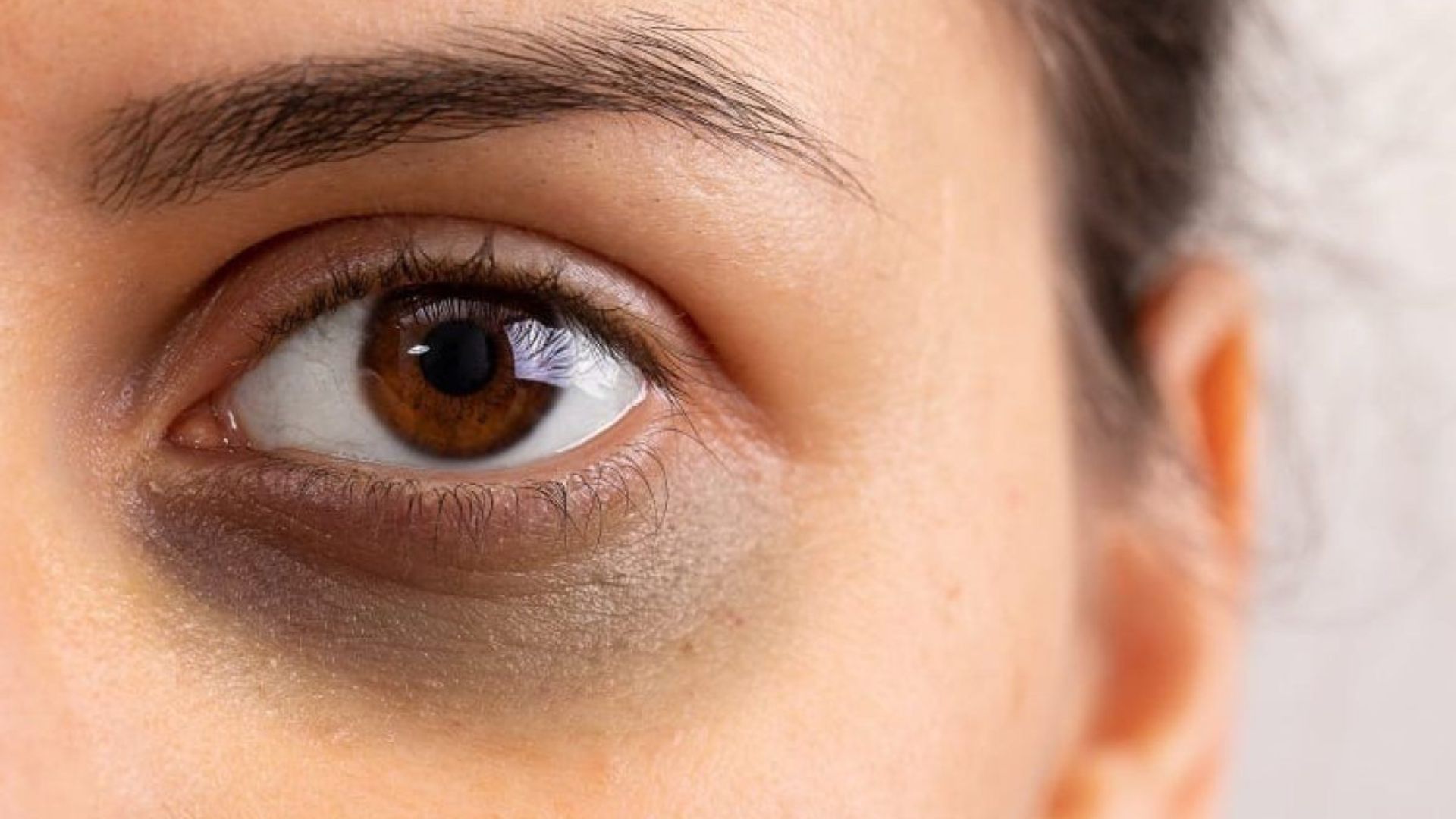 A woman with brown eyes, displaying a noticeable black eye on her right side.