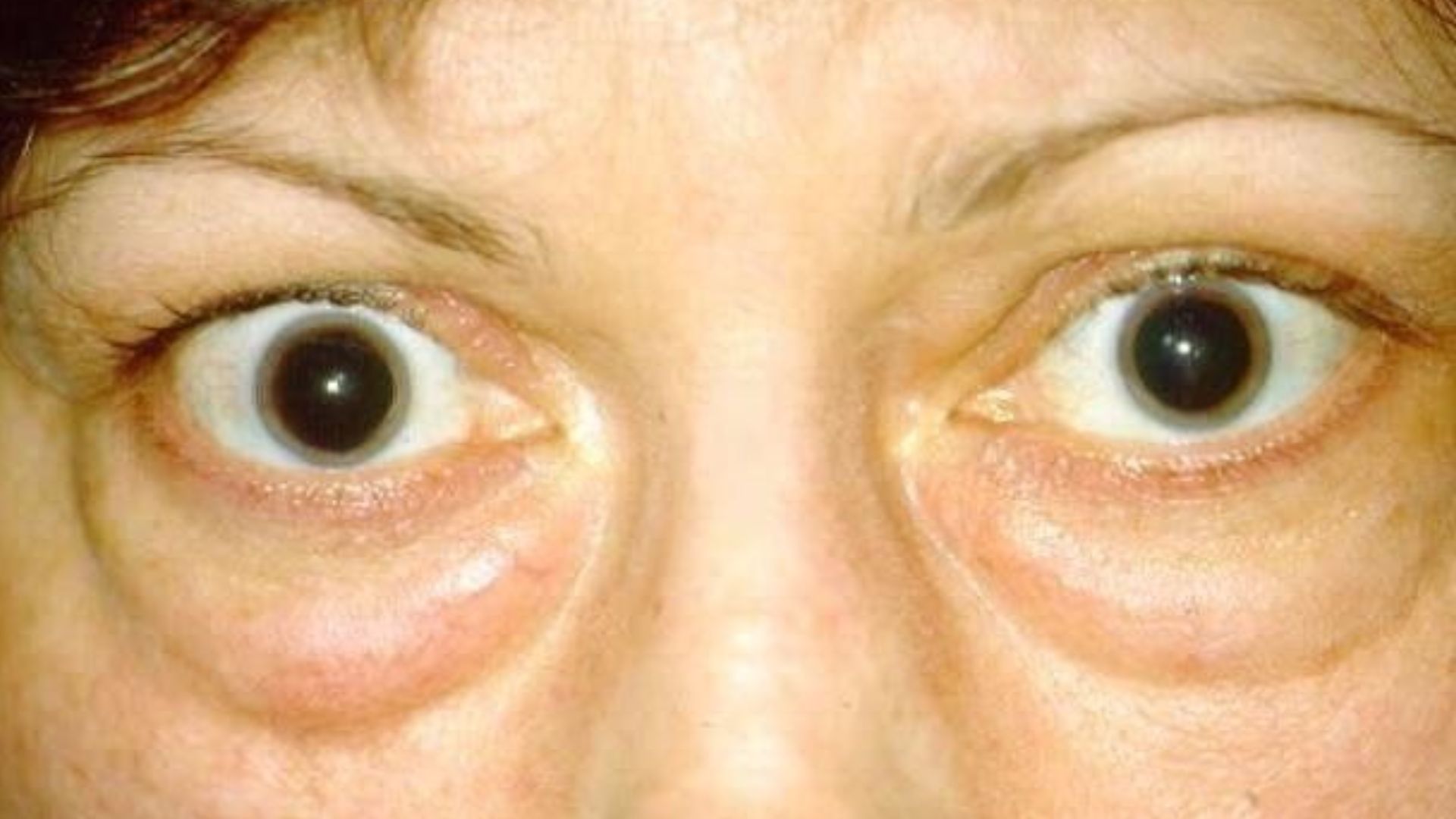 A woman with striking large eyes and a notable large nose, highlighting her individual characteristics.