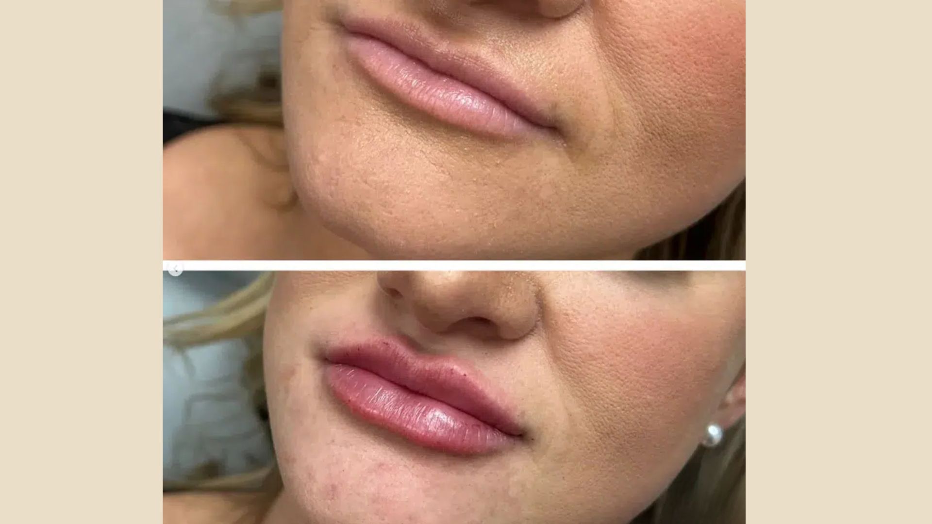 Before and after photos showcasing a woman's lips, highlighting changes in shape and fullness.