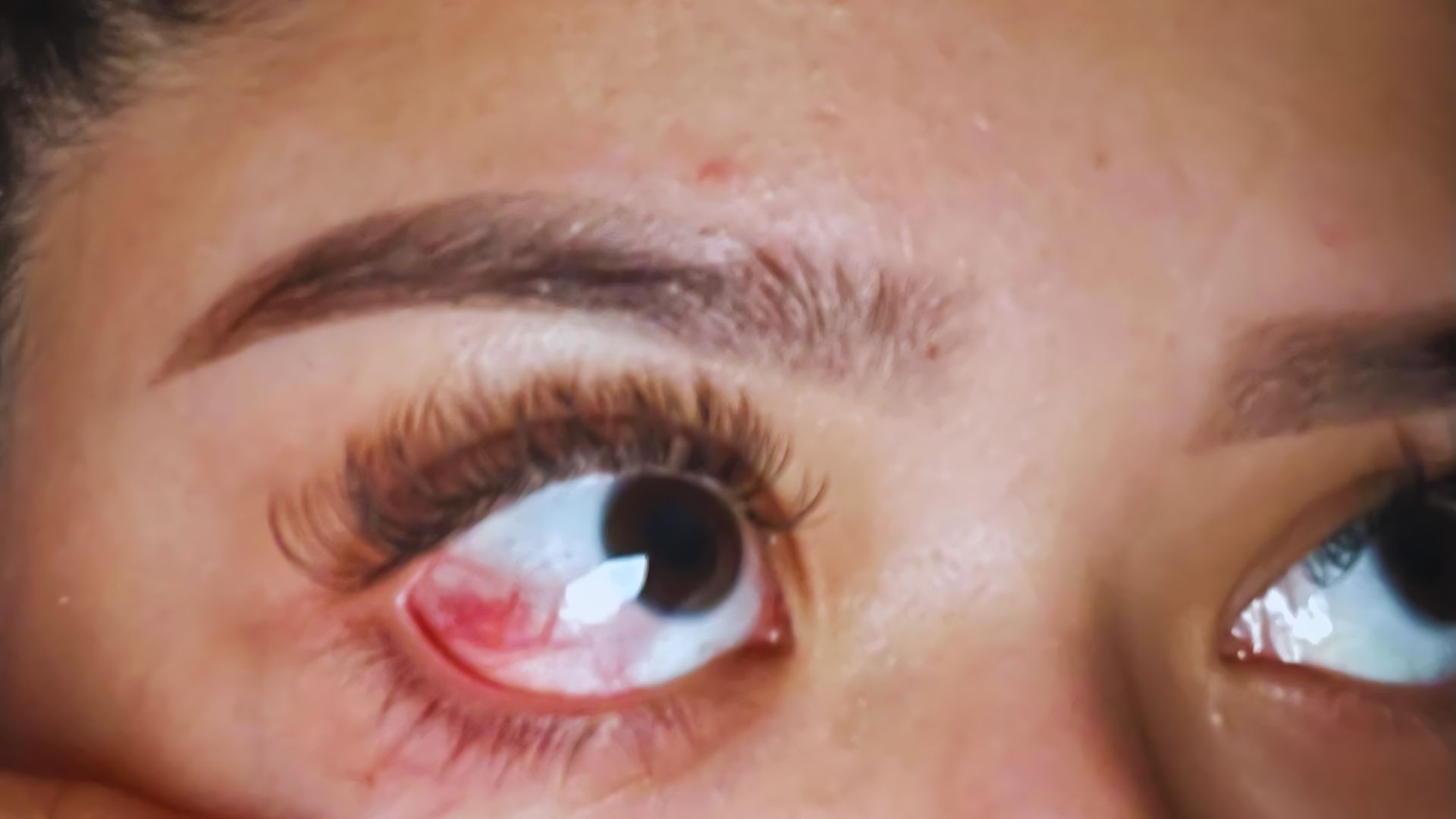 . A woman with a prominent nose and a red eye, looking directly at the camera with a neutral expression.