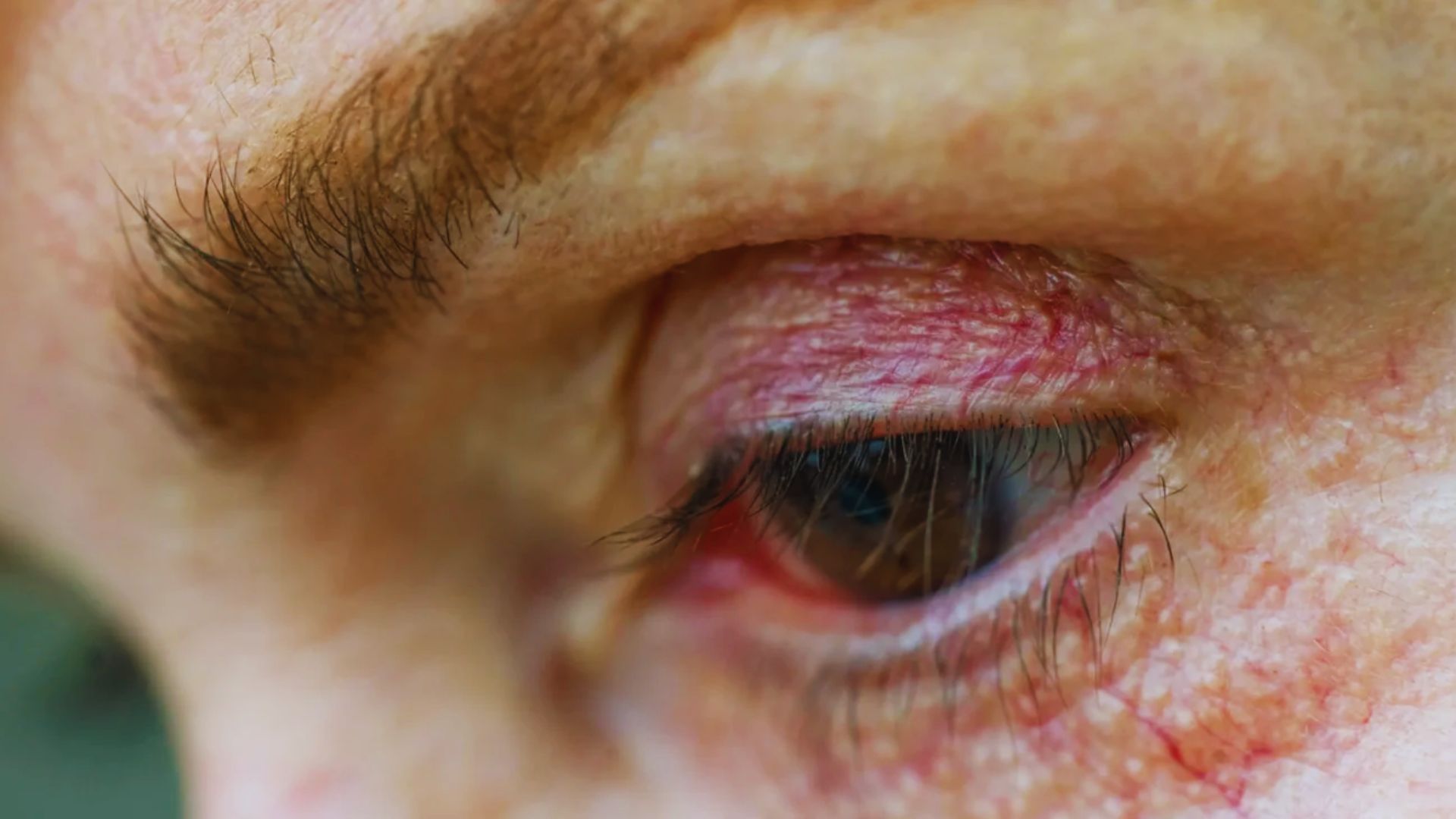 A woman with a red and swollen eye, showing signs of irritation or injury.