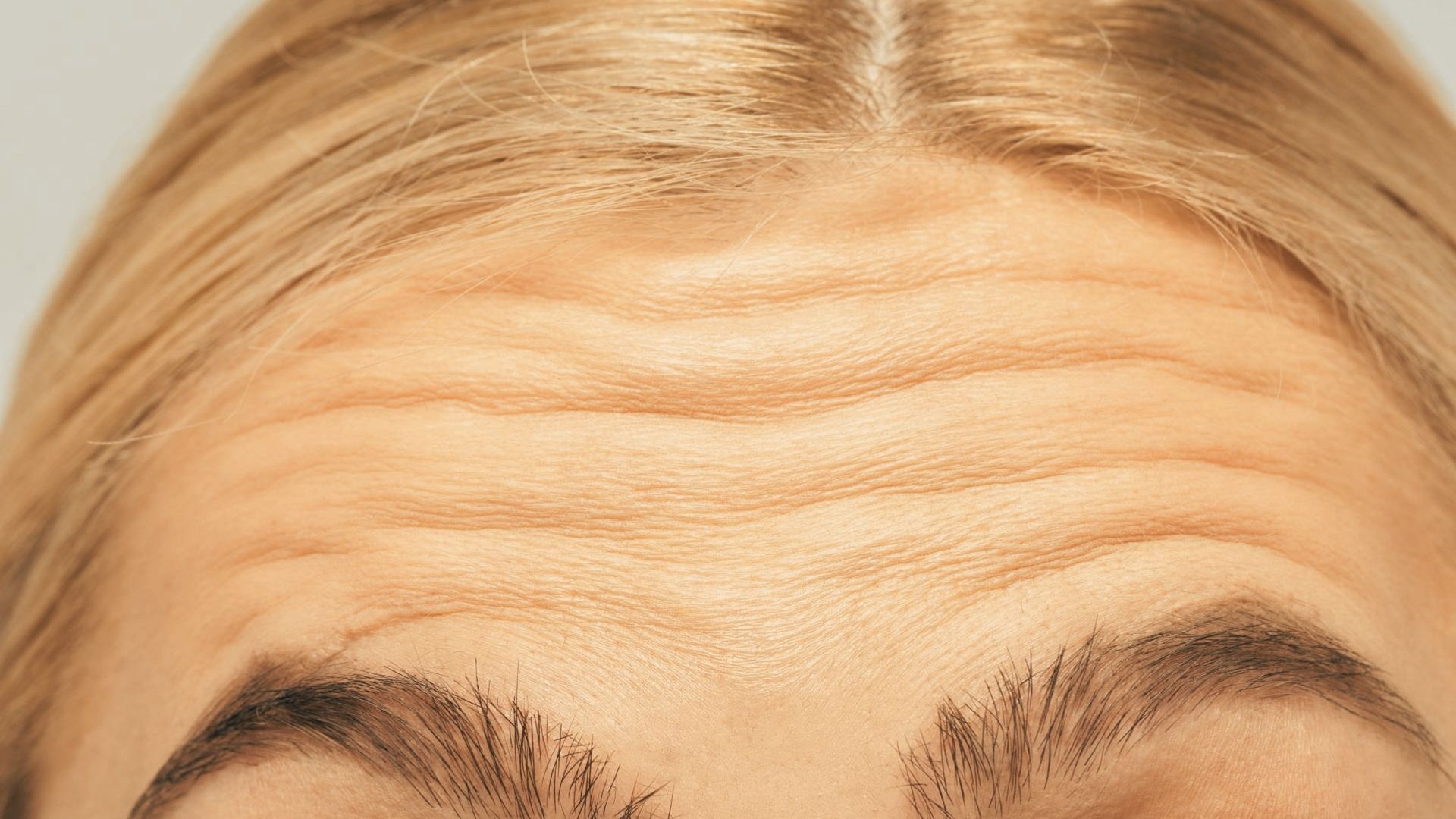 Forehead Lines