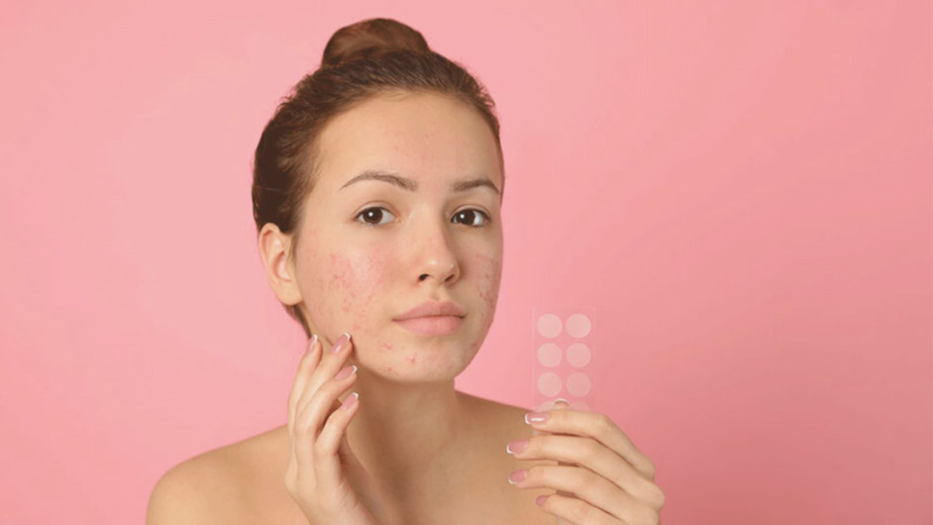 A woman with acne on her face, wearing a pimple patch on one of her blemishes.