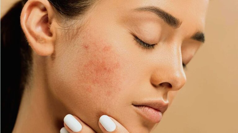 A woman with visible acne on her face, showcasing her natural skin texture and features.