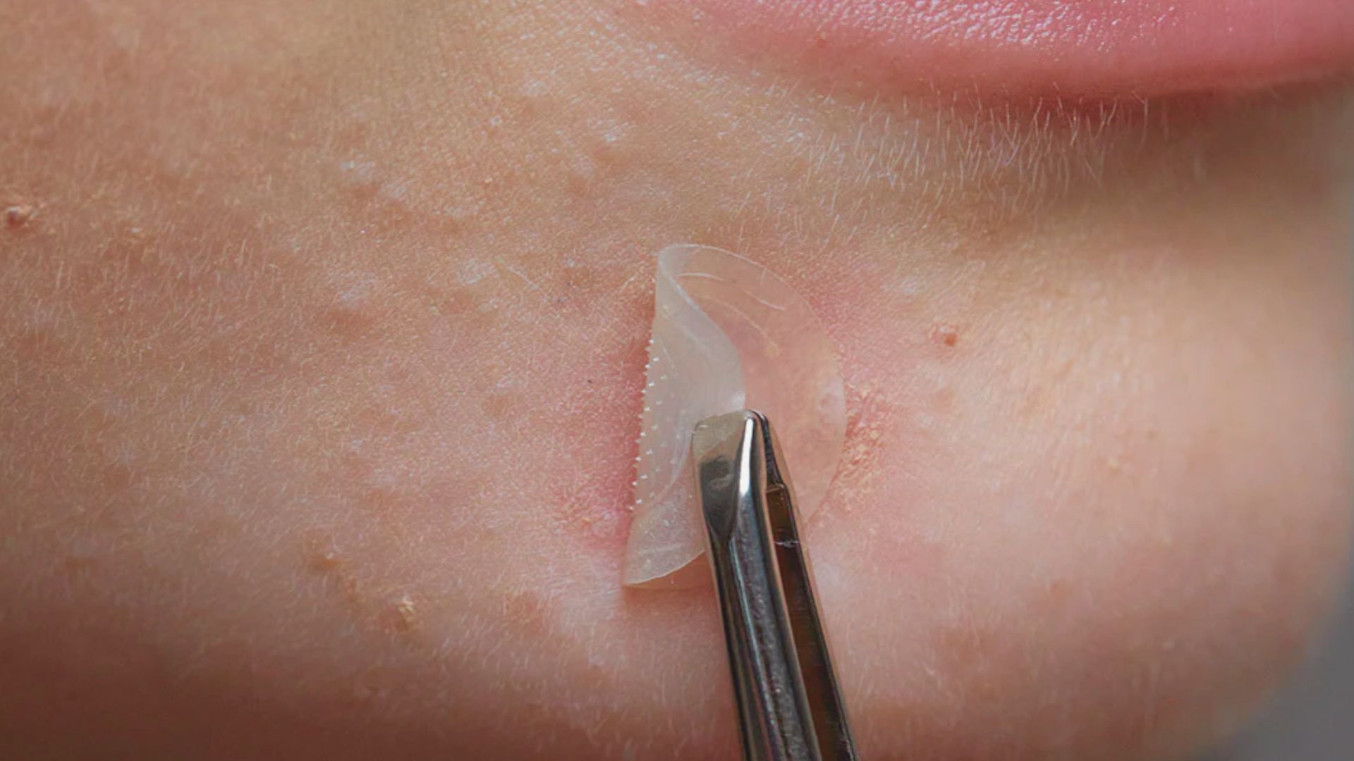 A person uses a small plastic tool to extract skin from a pimple on a blackhead.