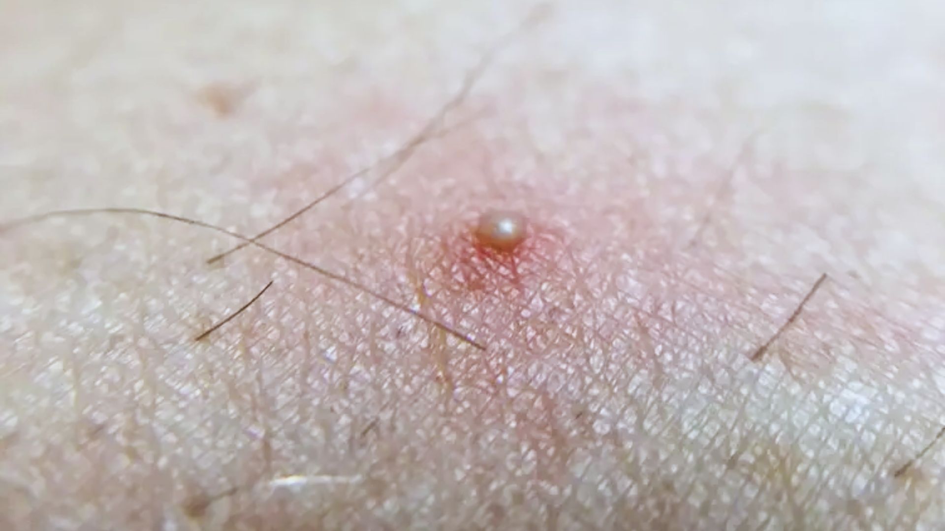 Can You Put a Pimple Patch