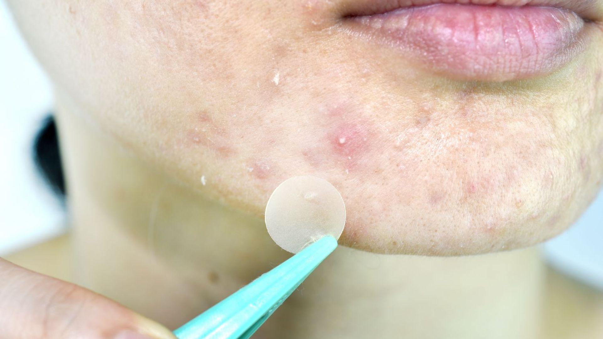 A woman wearing pimple patches on her clean, dry skin.