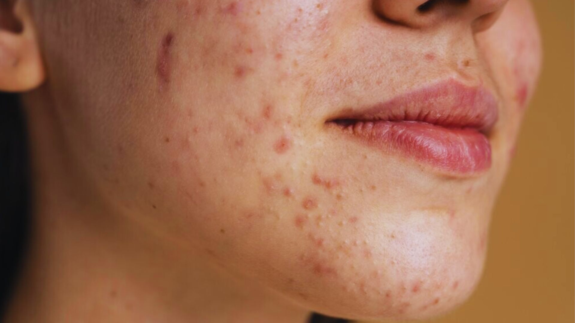 Close-up of a woman’s lips showing extensive acne, representing the peak purging stage of her skincare routine, weeks 3-6.