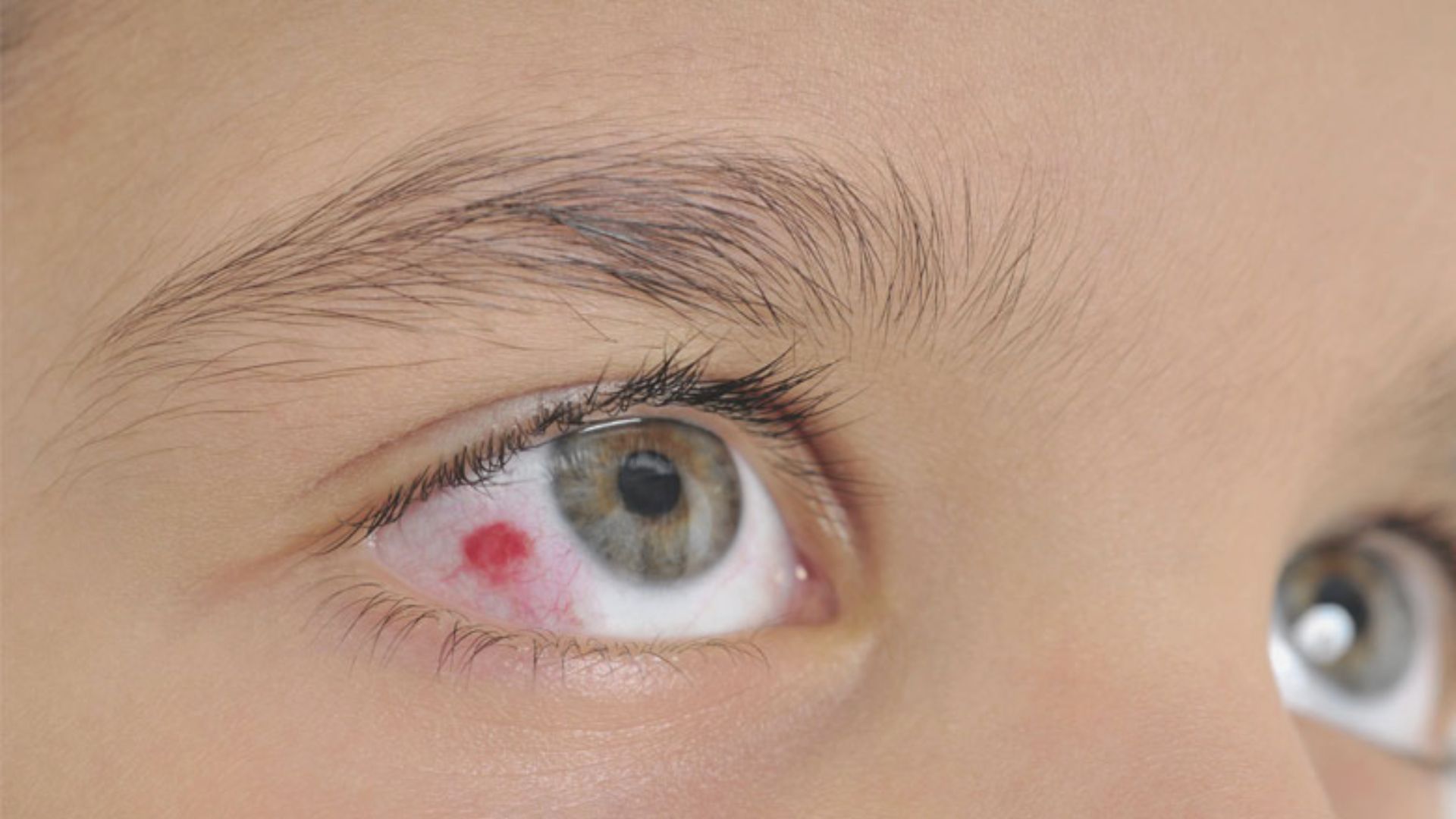 A child with a red eye and a white spot on the eyelid, looking directly at the camera with a neutral expression.