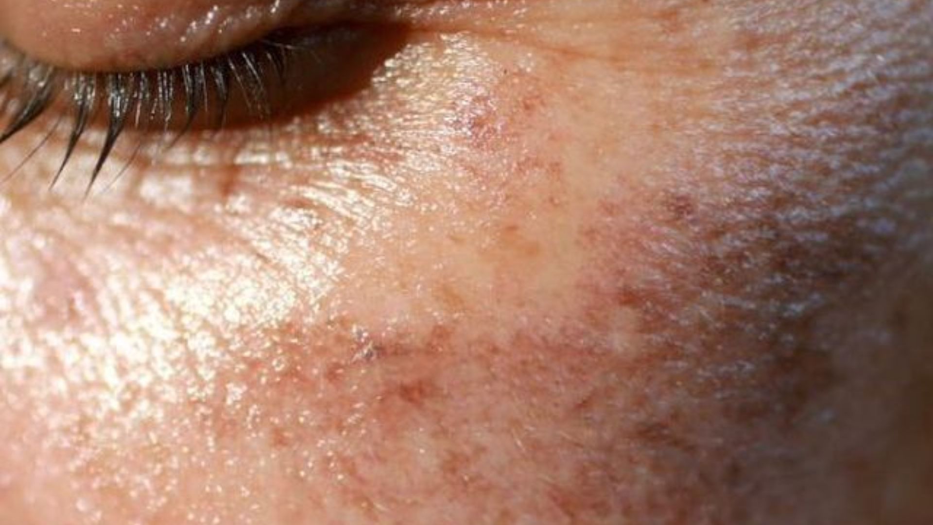 A close-up of a woman's face showcasing a prominent array of freckles across her cheeks and nose.