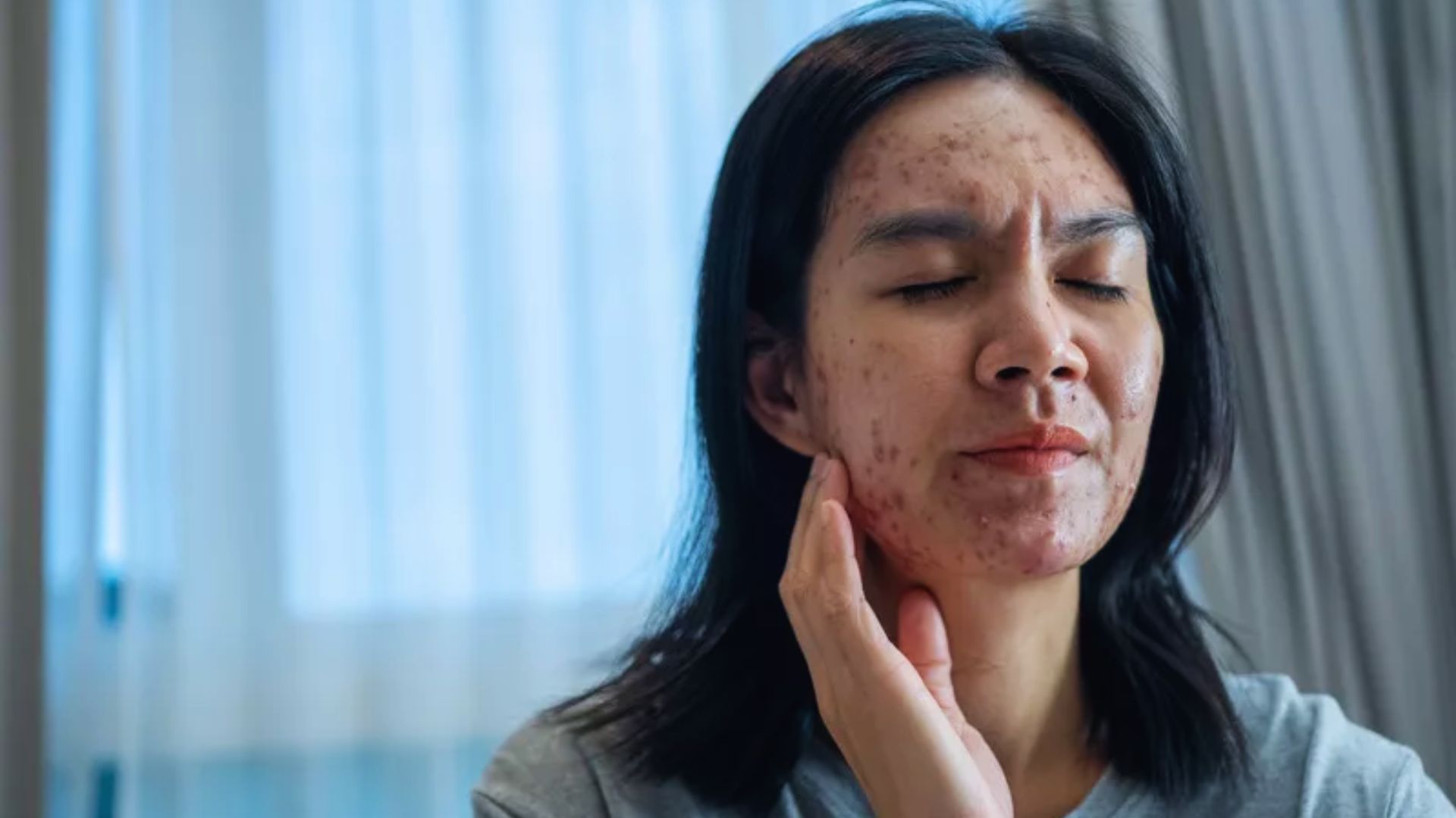 A woman with acne on her face, illustrating the effects of hard water on skin health.