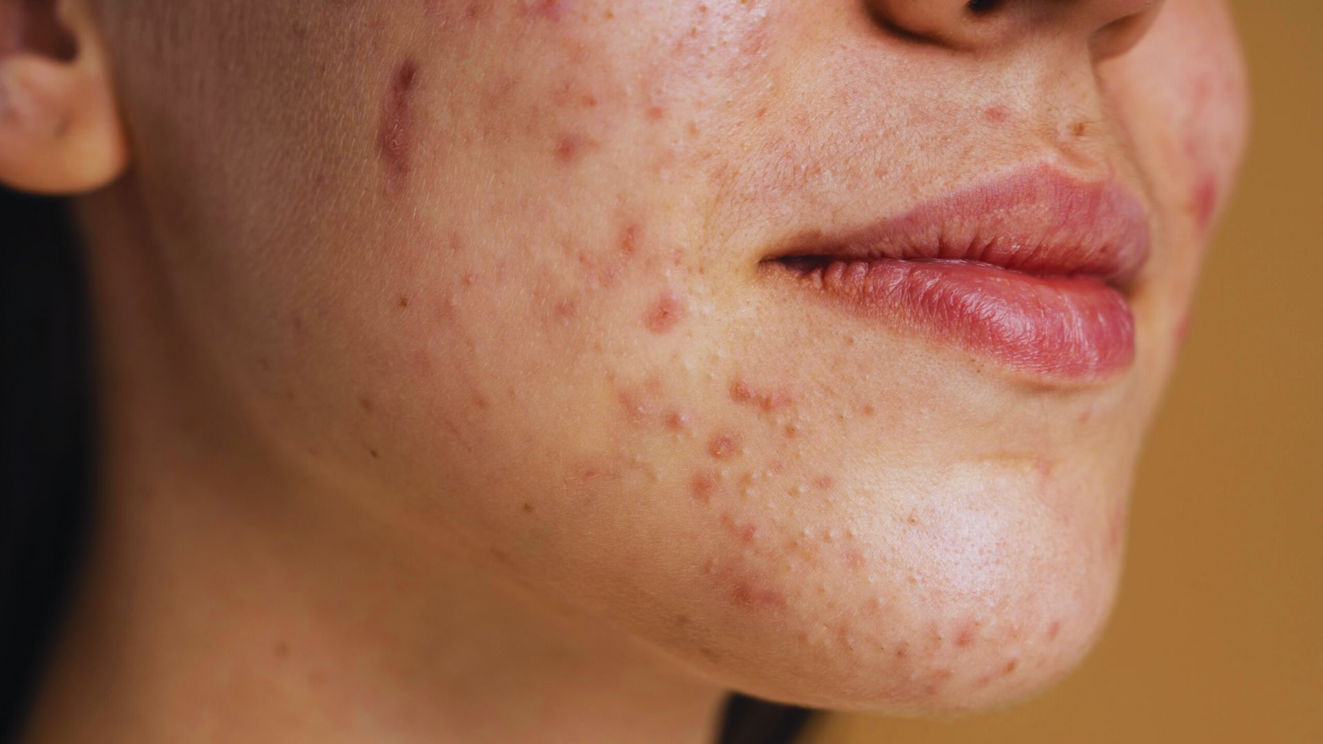 A close-up of a woman's face showing acne, highlighting the need for acne or rosacea treatment options.