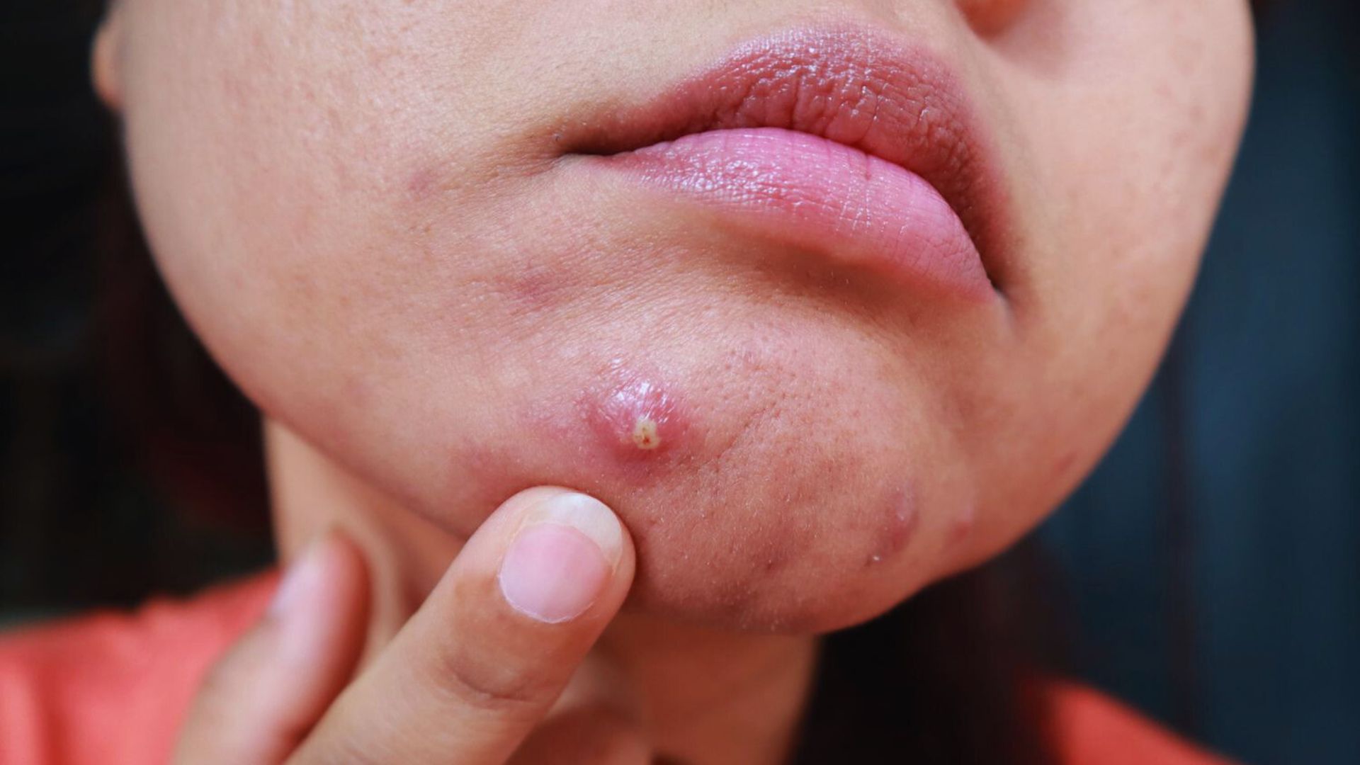 A woman showing cystic acne on her jawline, highlighting a prominent pimple on her face.