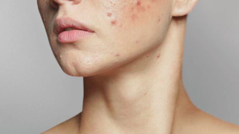 A close-up of a woman's face showing acne, with a focus on skin texture and blemishes related to skin purging.