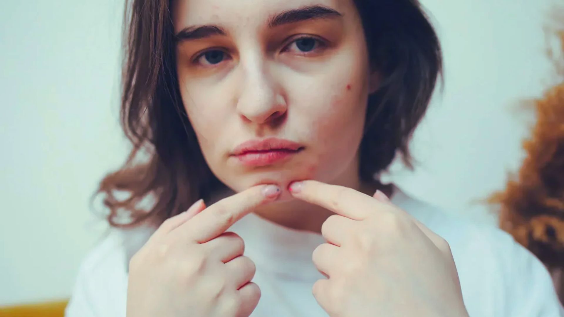 A woman rests her finger on her face, considering whether Creatine may lead to acne development.