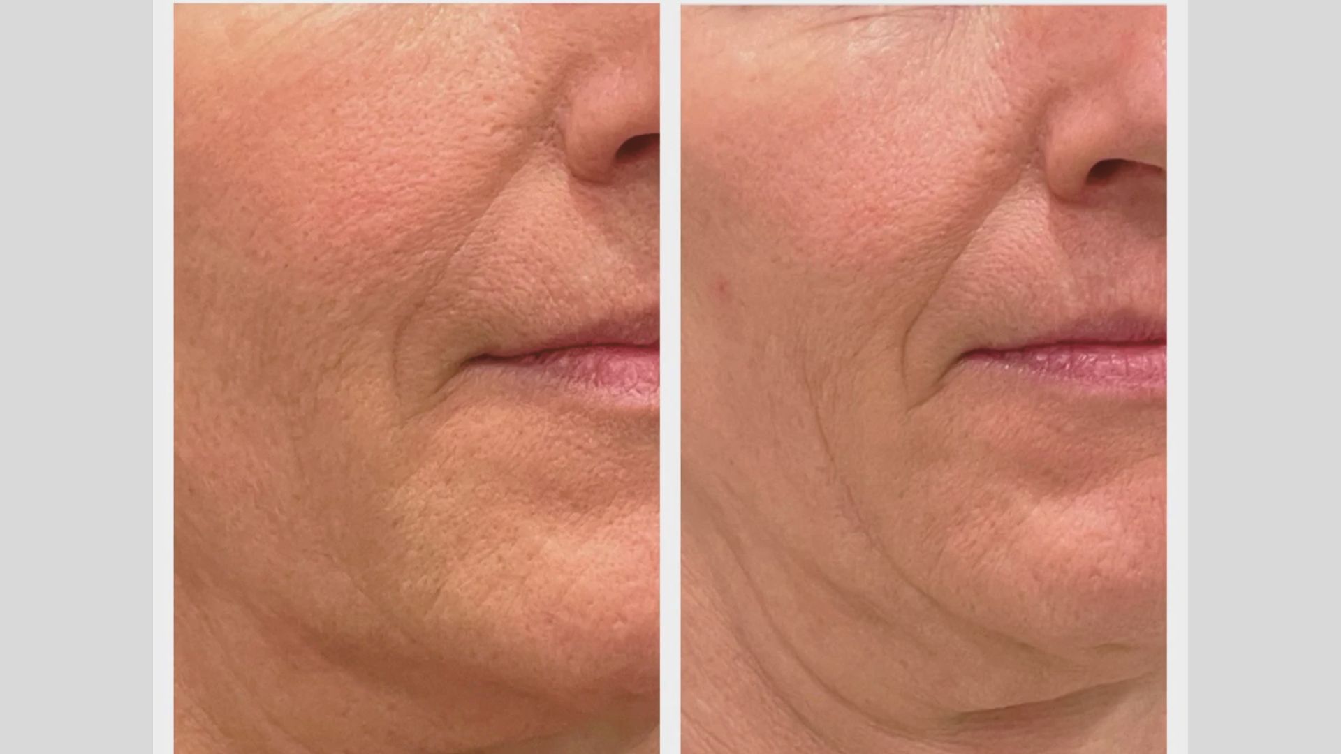 Before and after photos showcasing a woman's facial transformation, highlighting changes in skin and features.