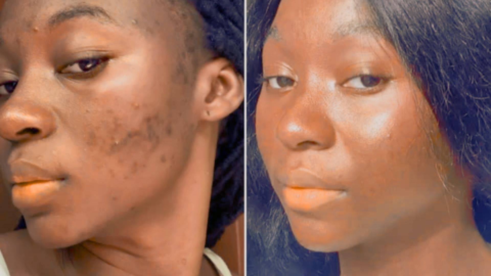 Two images of a woman showing her face with visible acne, highlighting different angles and expressions.