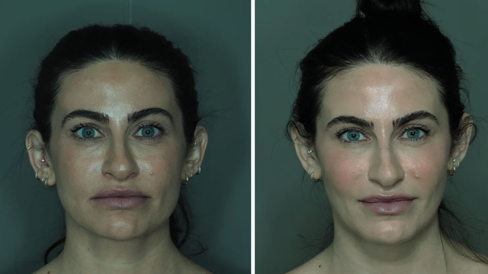2. Side-by-side comparison of a patient's nose before and after rhinoplasty, highlighting the surgical changes made.